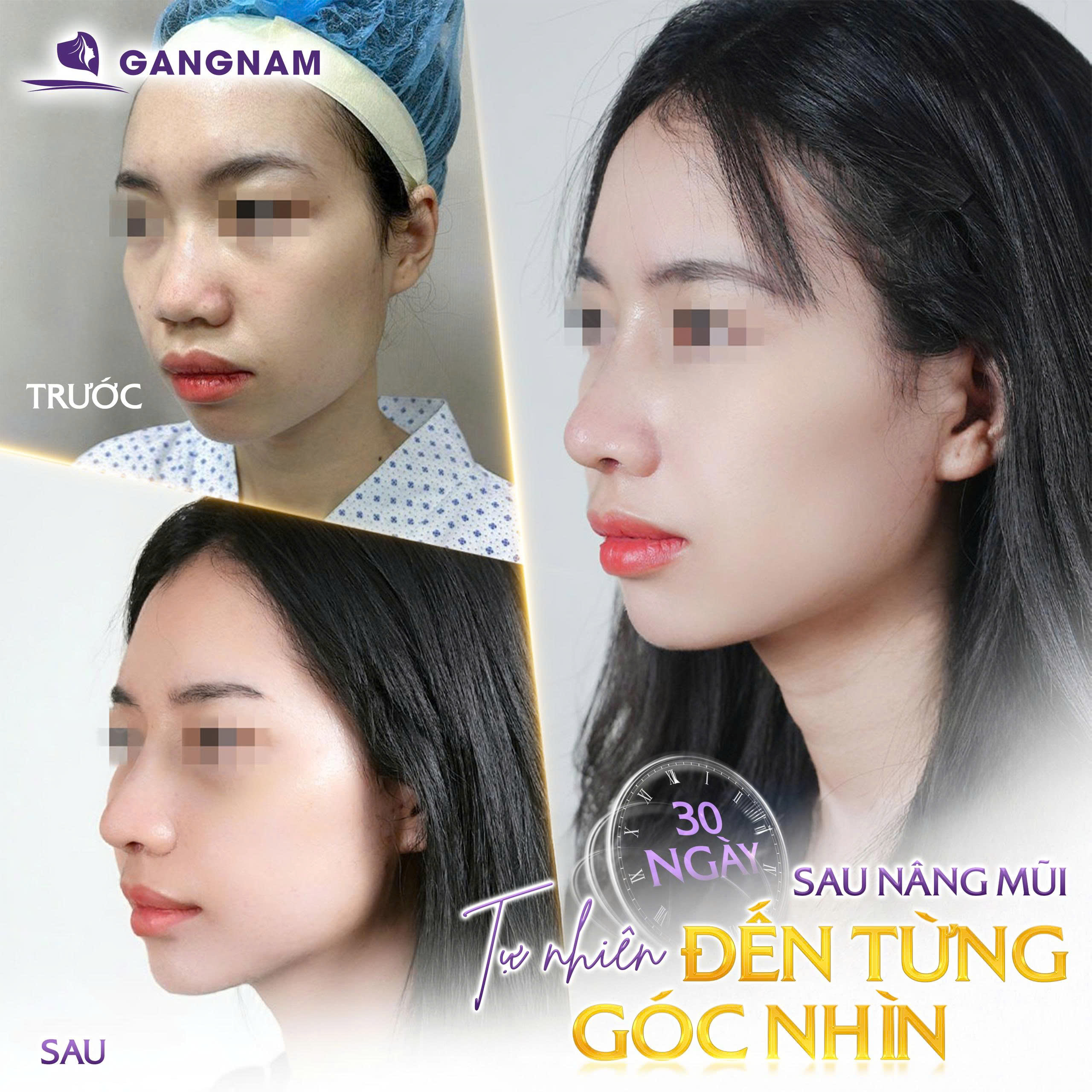Nâng Mũi Cấu Trúc Nội Soi – Giải Pháp Tái Cấu Trúc Toàn Diện Dáng Mũi Hiện Đại 4 Nâng mũi cấu trúc nội soi là gì?