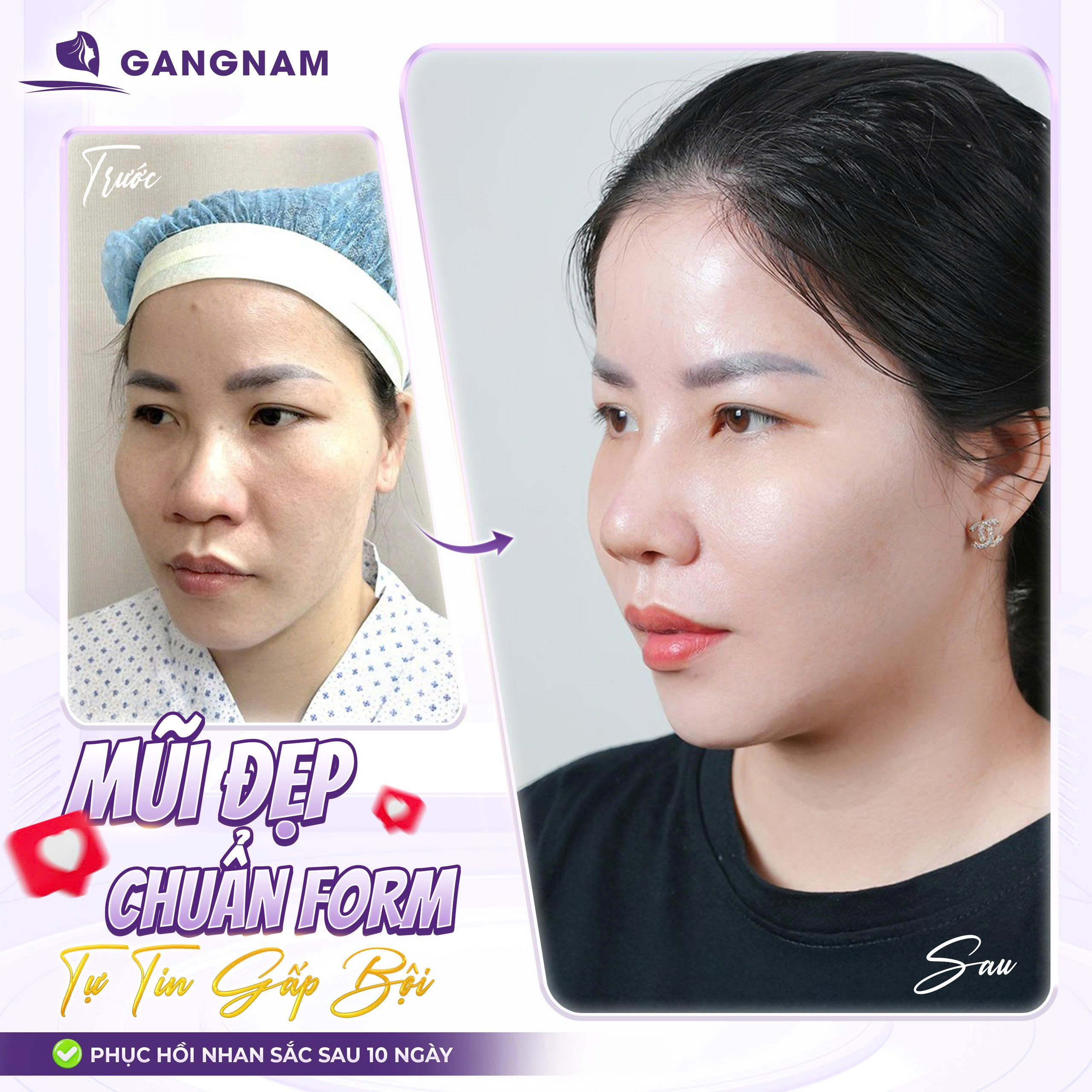 Tái cấu trúc mũi hỏng chuẩn y khoa: Lấy lại dáng mũi đẹp và chức năng hô hấp 5 Tái cấu trúc mũi hỏng chuẩn y khoa: Lấy lại dáng mũi đẹp và chức năng hô hấp 2