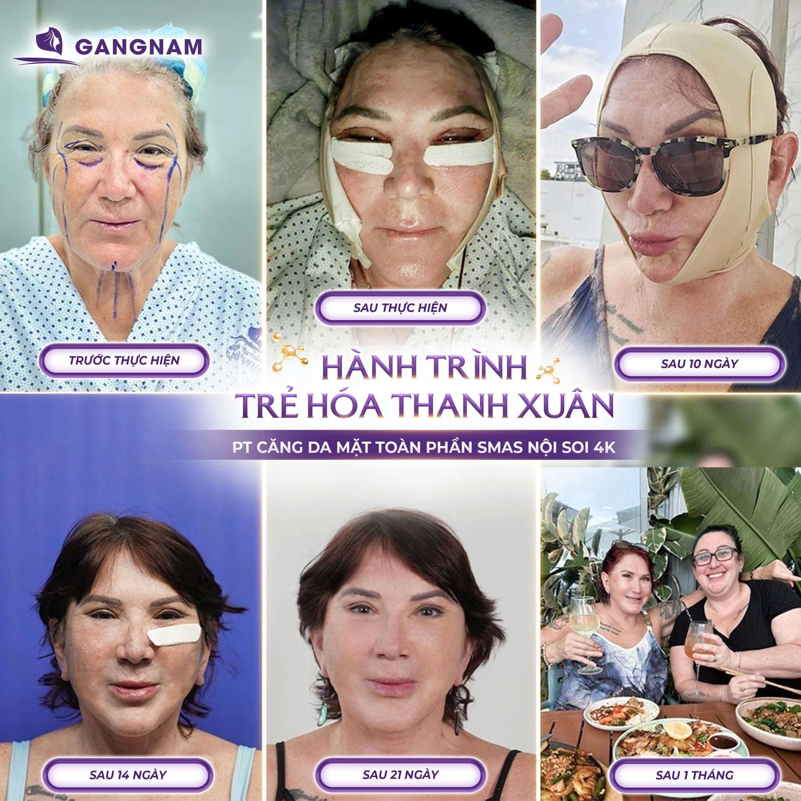 Căng Da Mặt Toàn Phần SMAS Nội Soi – Trẻ Hóa Sâu, Duy Trì Lâu Dài, Tự Nhiên 6 CĂNG DA MẶT TOÀN PHẦN SMAS NỘI SOI – GIẢI PHÁP TRẺ HÓA TOÀN DIỆN