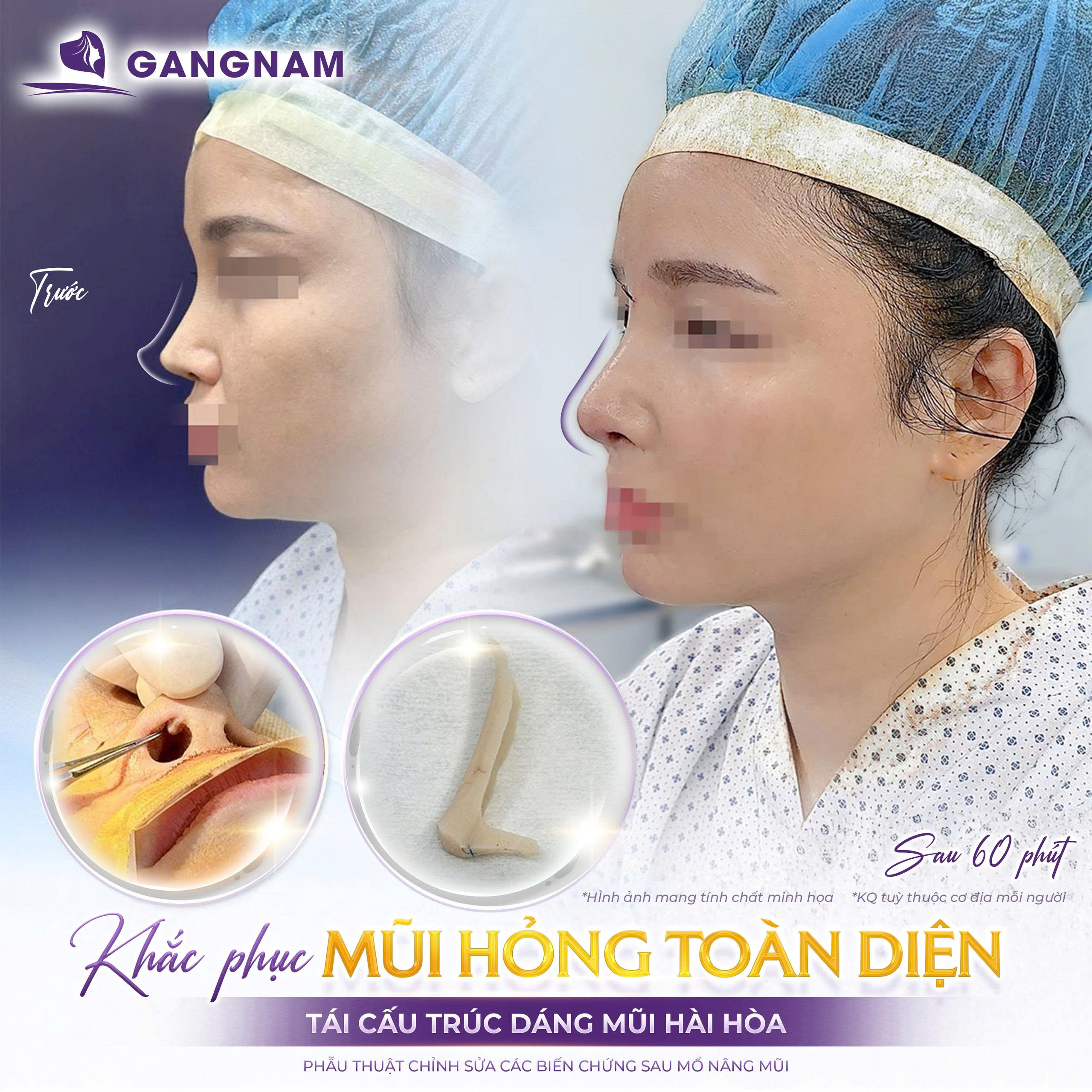 Tái cấu trúc mũi hỏng chuẩn y khoa: Lấy lại dáng mũi đẹp và chức năng hô hấp 4 Tái cấu trúc mũi hỏng là gì