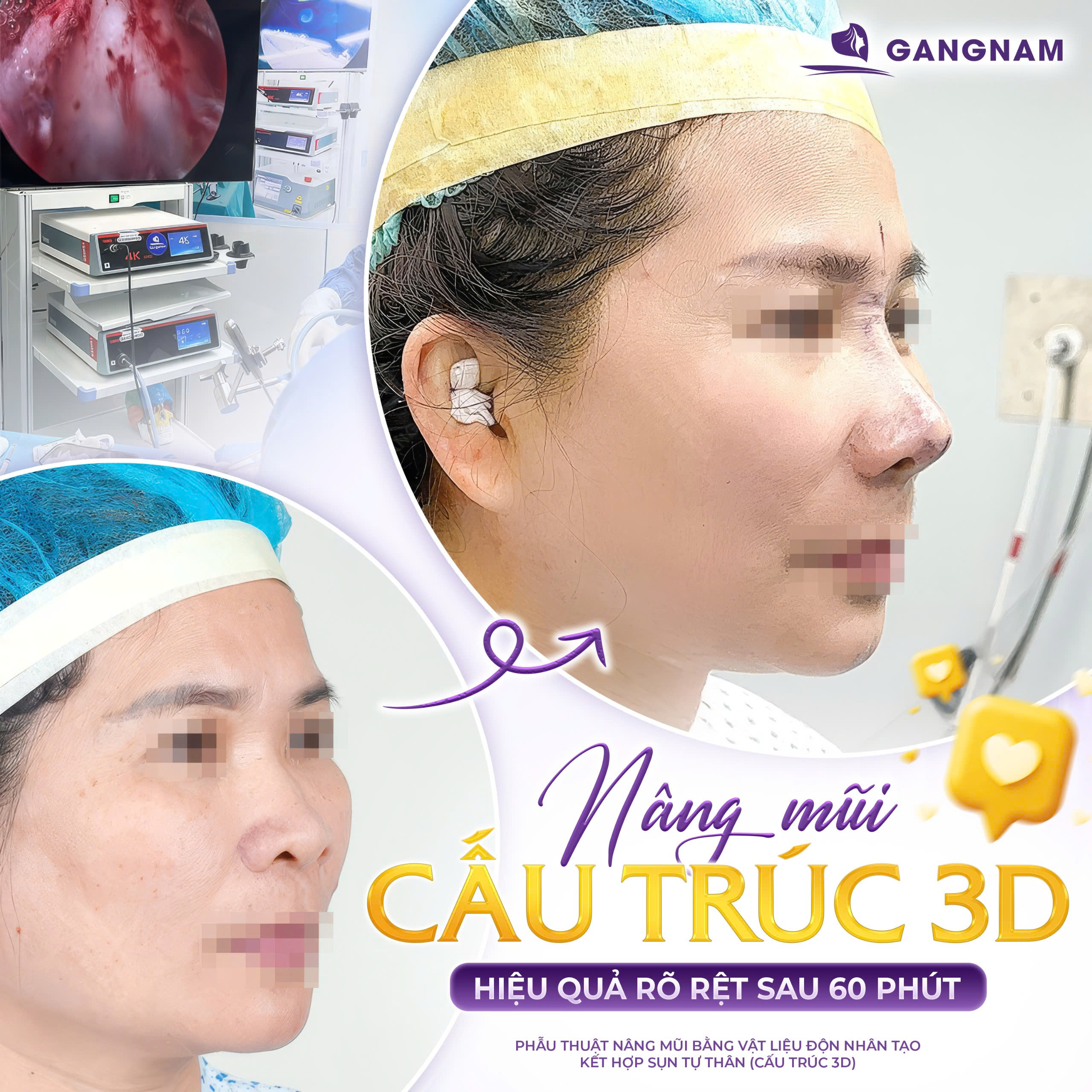 Nâng Mũi Chuẩn Y Khoa: Giải Pháp Tạo Dáng Mũi An Toàn, Tự Nhiên 4 Nâng mũi chuẩn y khoa là gì