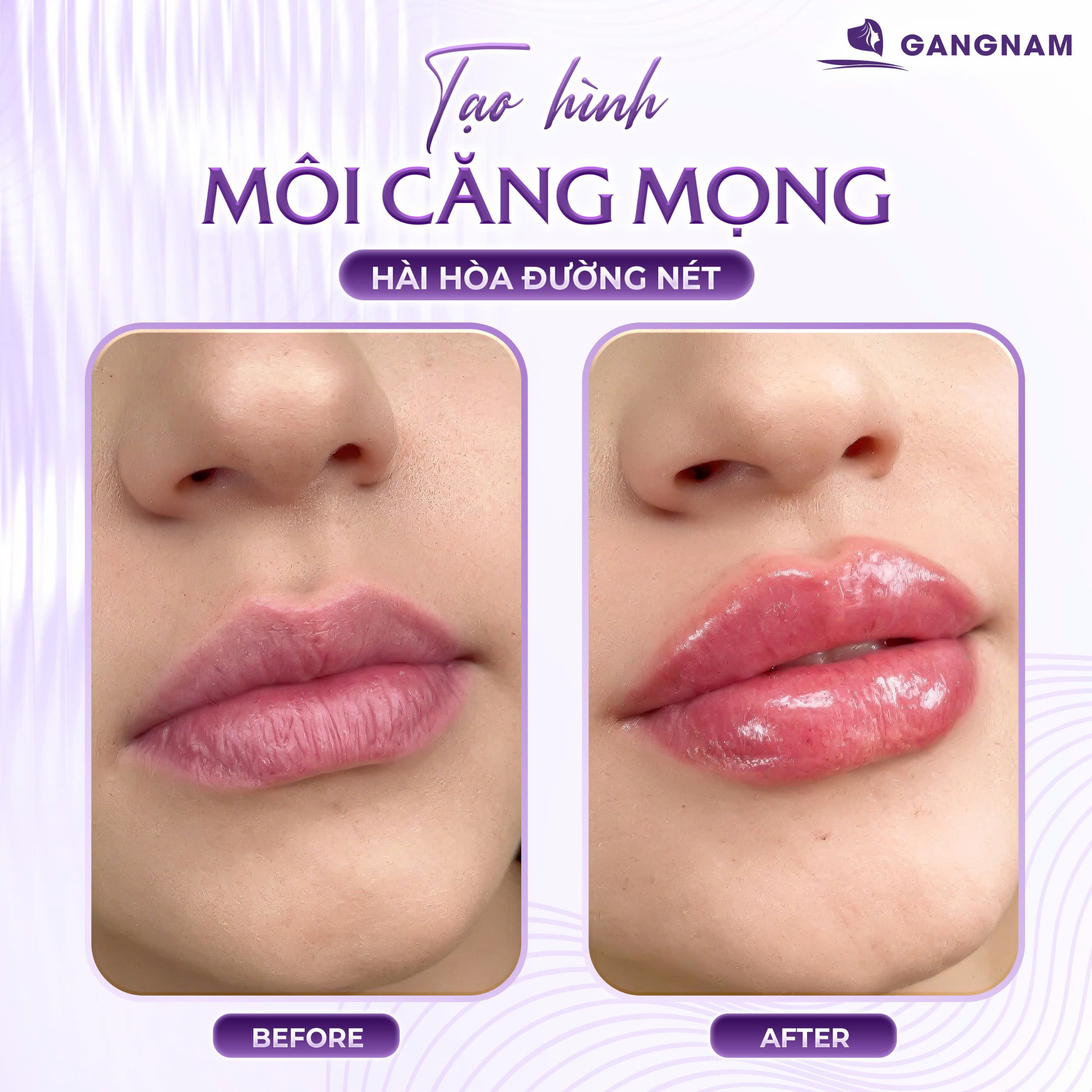 Tiêm filler môi cherry: Bí quyết sở hữu đôi môi căng mọng ngọt ngào 6 Tiêm filler môi cherry tại Thẩm mỹ Gangnam