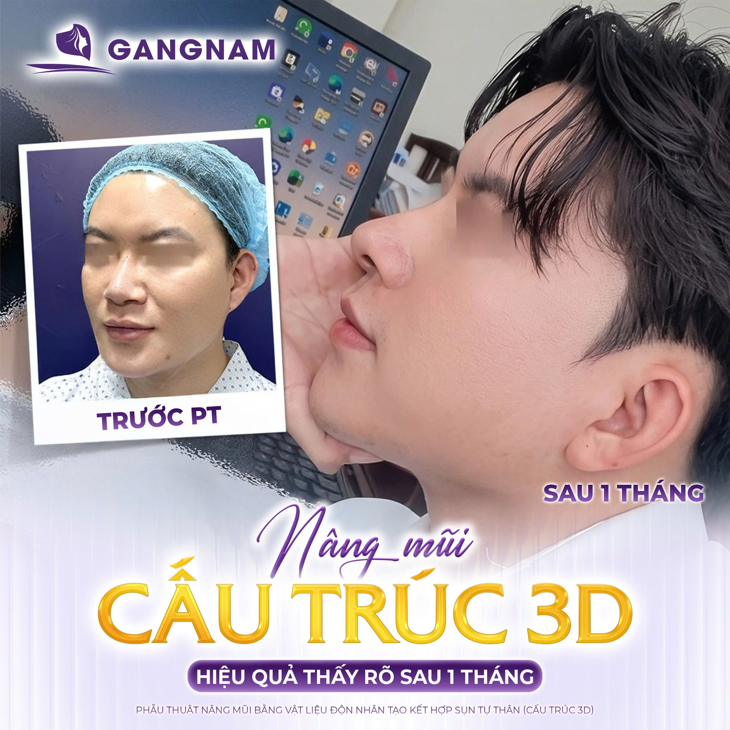 Nâng mũi cấu trúc bọc sụn: Giải pháp toàn diện cho dáng mũi đẹp tự nhiên 4 Phương pháp nâng mũi cấu trúc bọc sụn là gì?