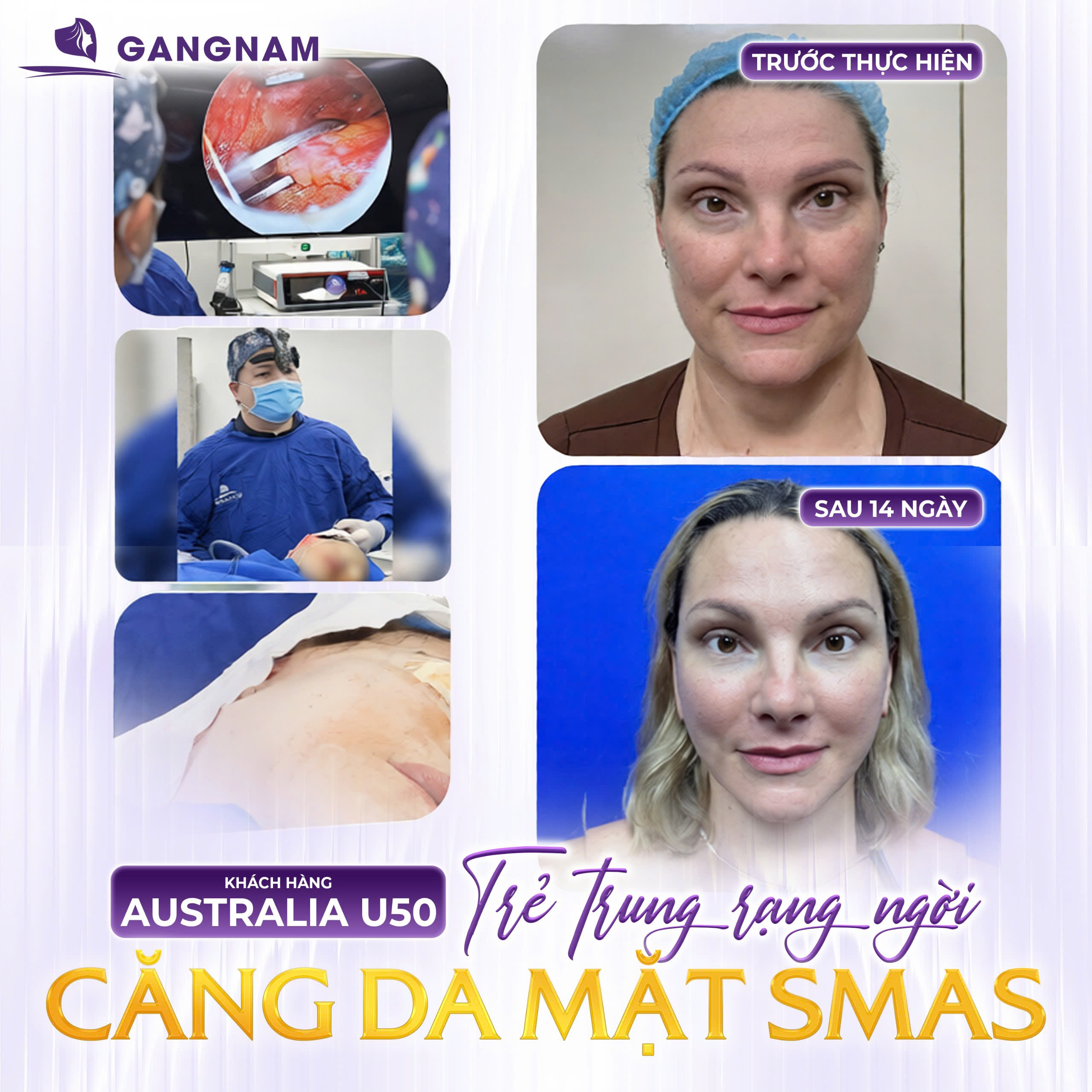 Phẫu thuật căng da mặt nội soi 4k: Đỉnh cao công nghệ trẻ hóa toàn diện 6 Căng da mặt nội soi 4K tại Thẩm mỹ Gangnam