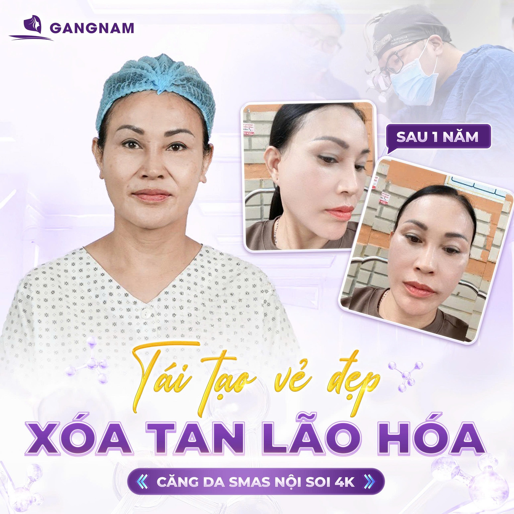 Bí quyết trẻ hóa toàn diện với công nghệ căng da má nội soi 4k 6 Căng da má nội soi 4K tại Thẩm mỹ Gangnam – Trẻ hóa tự nhiên, an toàn