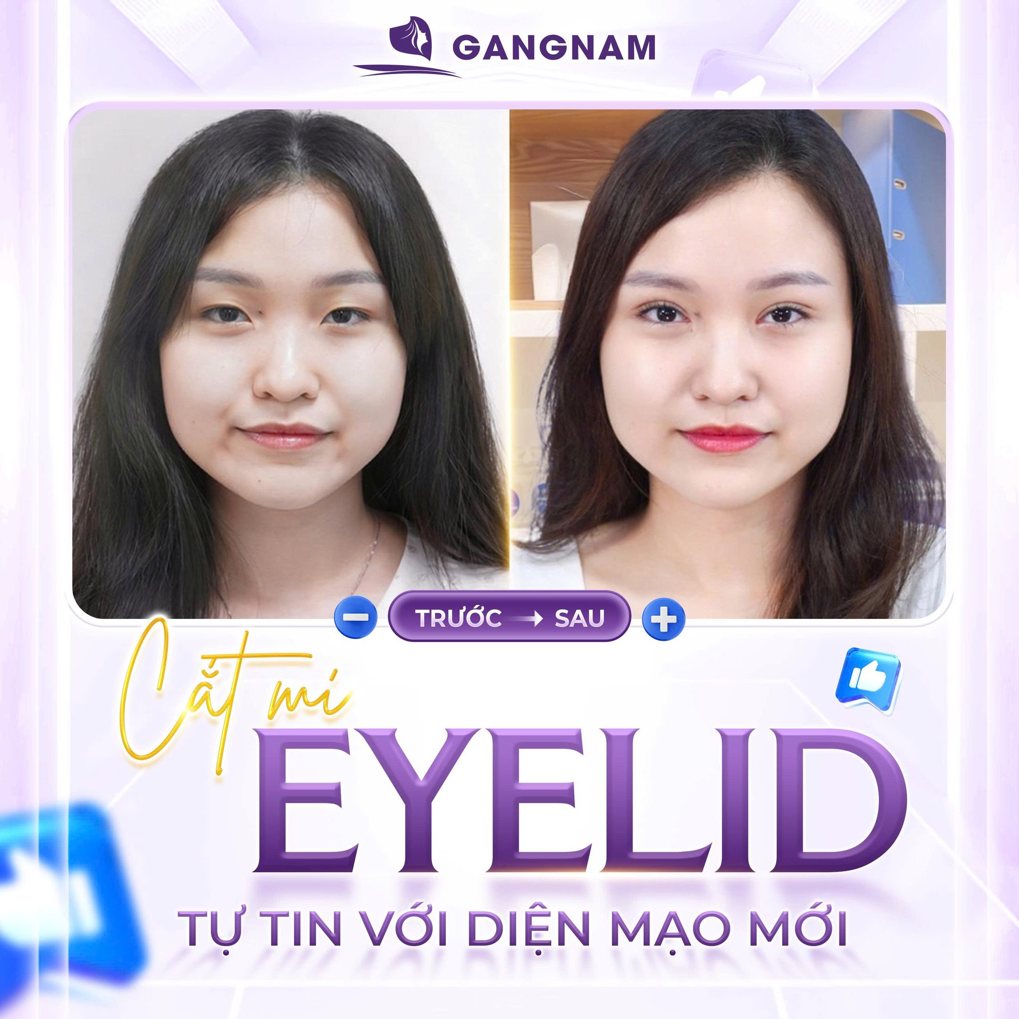 Cắt mí mini eyelid: Giải pháp kiến tạo đôi mắt hai mí tự nhiên và bền vững 6 Cắt mí mini eyelid tại Thẩm mỹ Gangnam – Tinh tế trong từng chi tiết