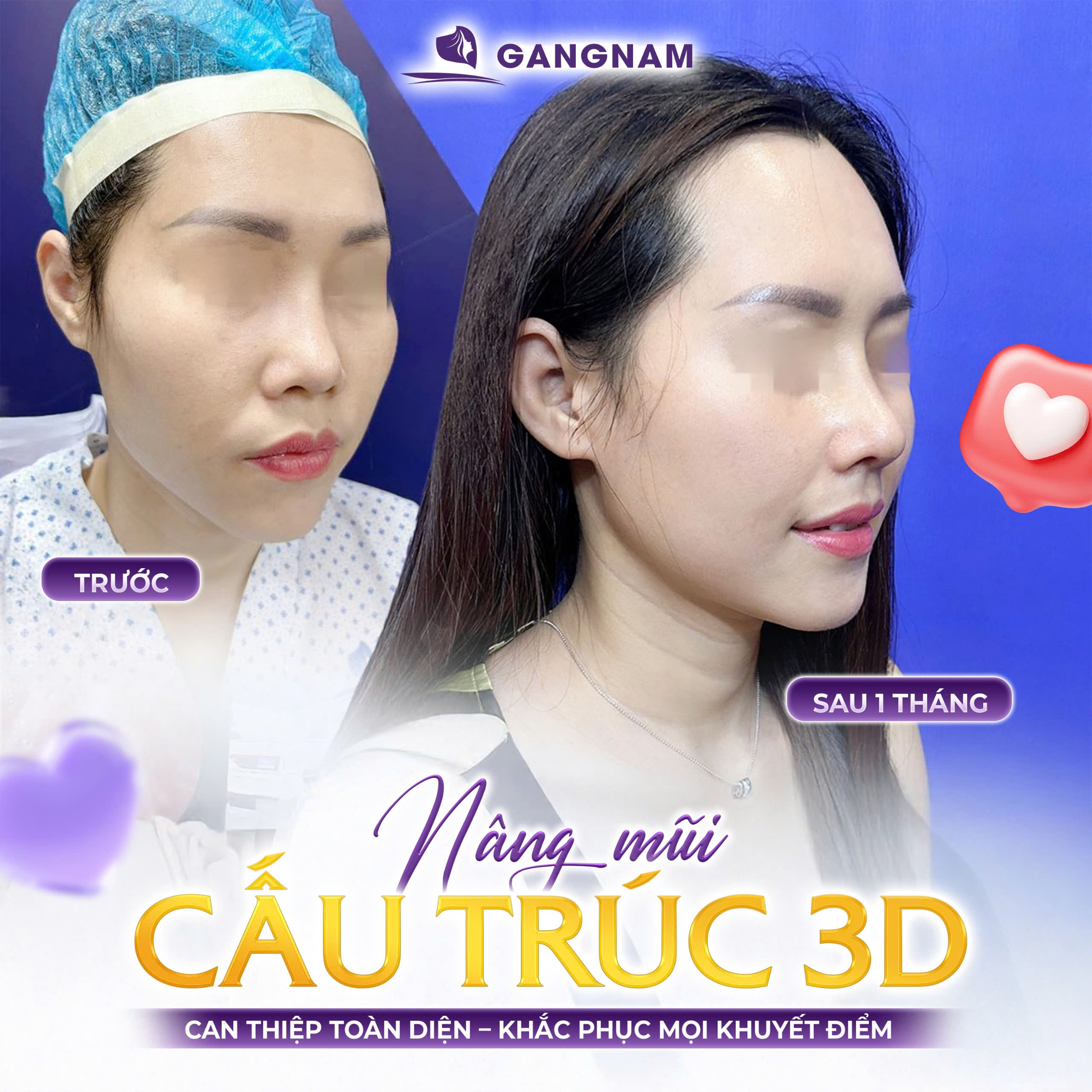 Nâng mũi cấu trúc nội soi: Giải pháp toàn diện cho dáng mũi tỷ lệ vàng 4 Tìm hiểu phương pháp nâng mũi cấu trúc nội soi là gì?