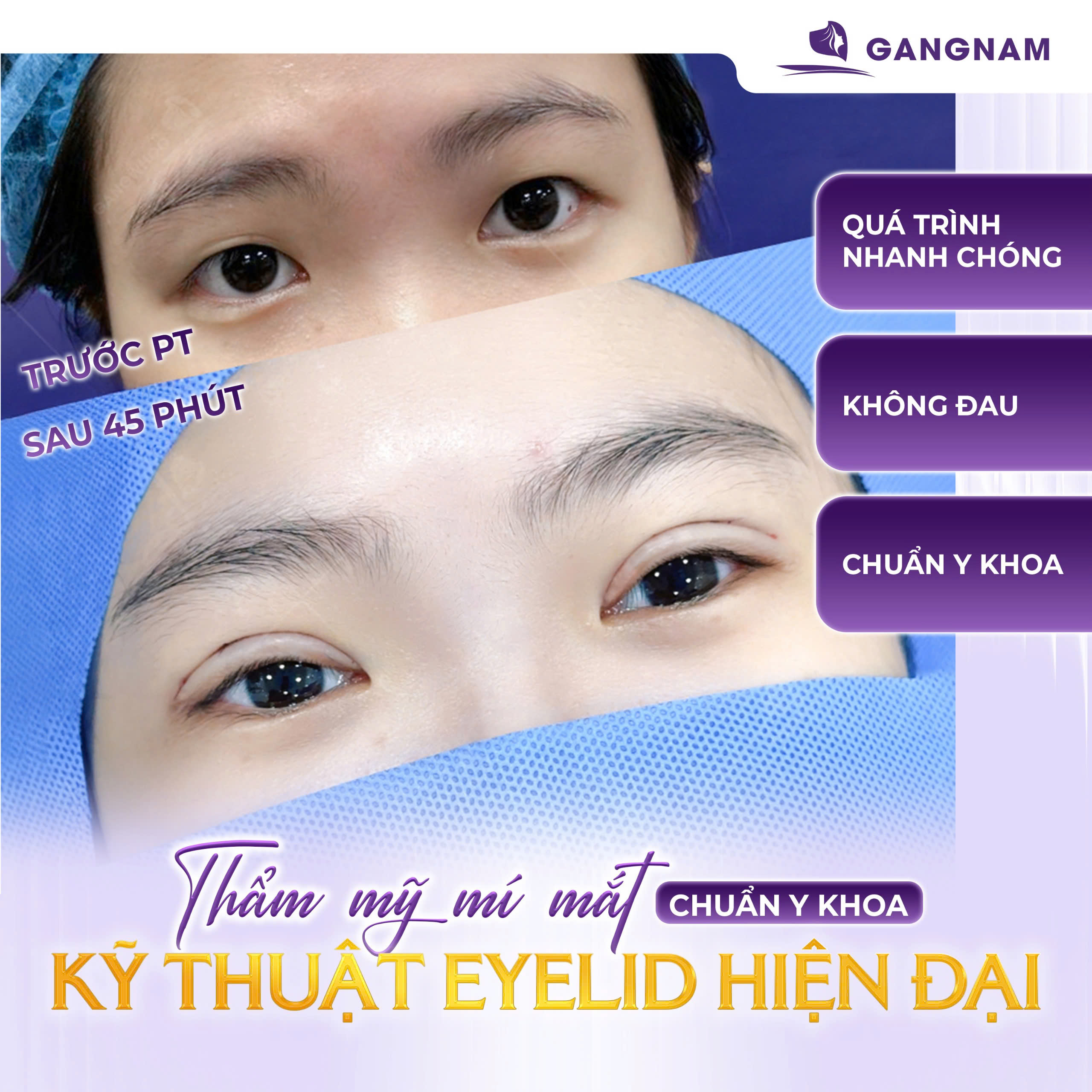 Cắt mí mini eyelid: Giải pháp kiến tạo đôi mắt hai mí tự nhiên và bền vững 4 Tìm hiểu kỹ thuật thực hiện cắt mí mini eyelid chuyên sâu