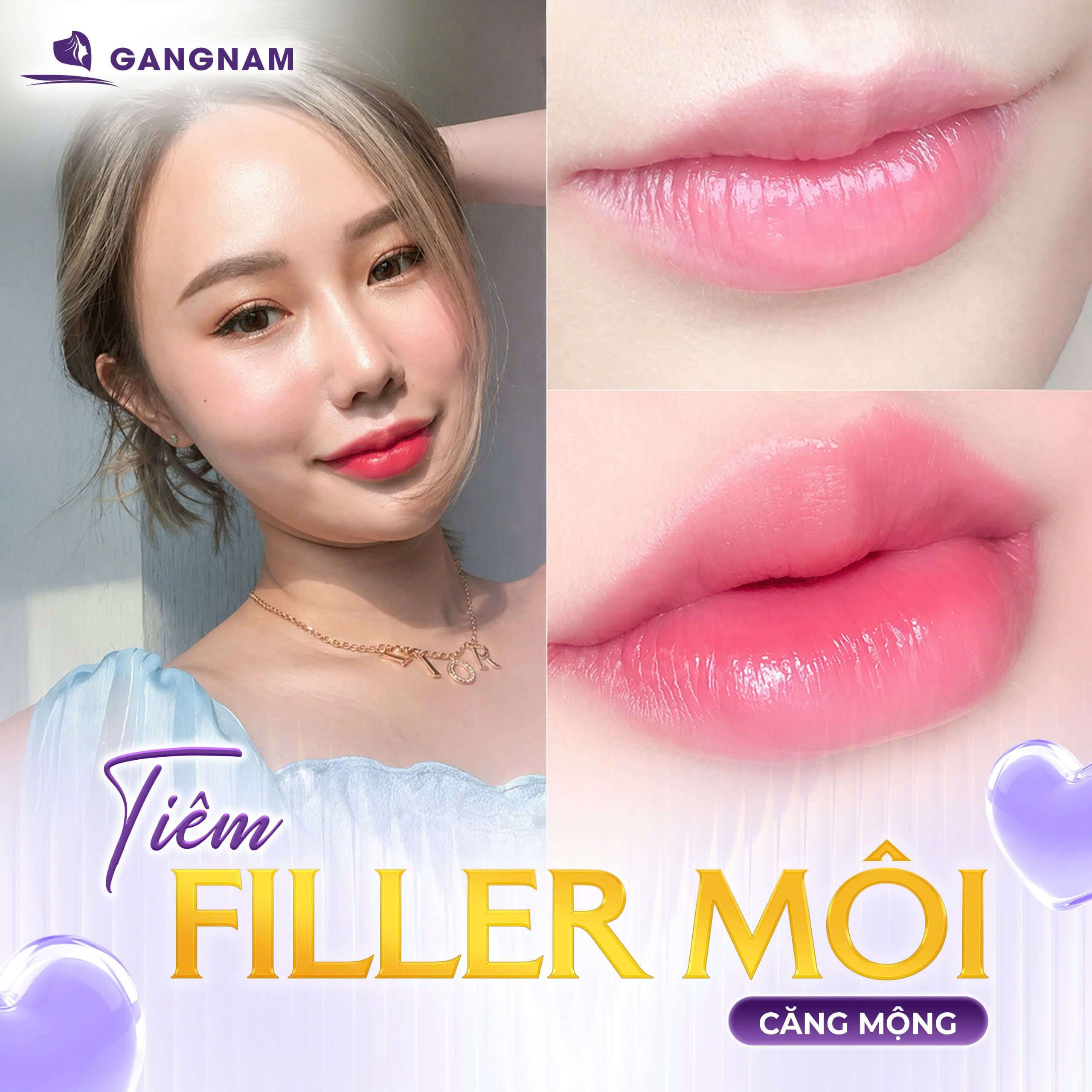 Tiêm Filler Môi Trái Tim Hàn Quốc: Xu Hướng Làm Đẹp Chuẩn Tỉ Lệ Vàng 4 Tiêm filler môi trái tim Hàn Quốc là gì?