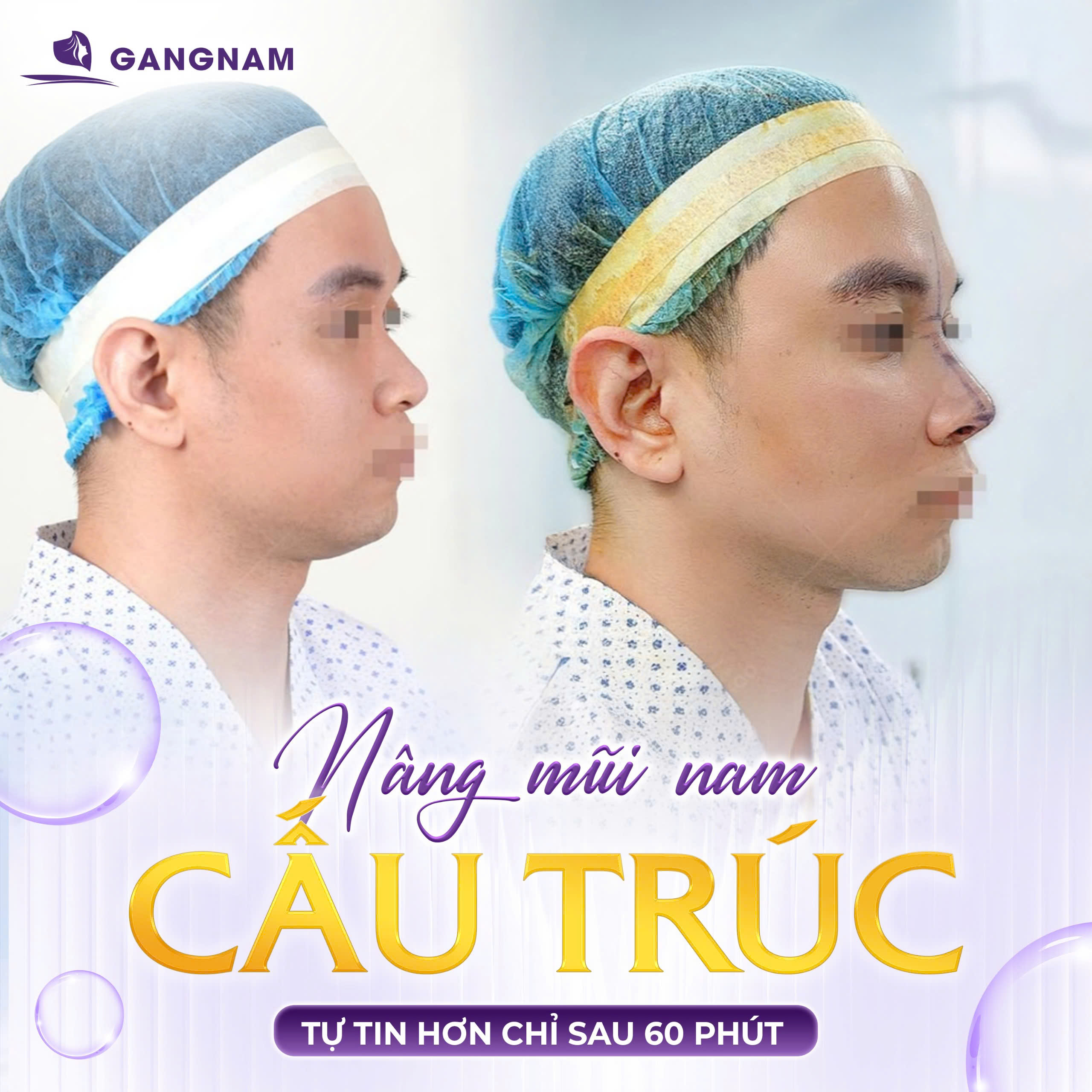 Nâng mũi cấu trúc S-Line: Giải pháp hoàn hảo cho vẻ đẹp tự nhiên 4 Nâng mũi cấu trúc S-Line là gì và tại sao lại được ưa chuộng?