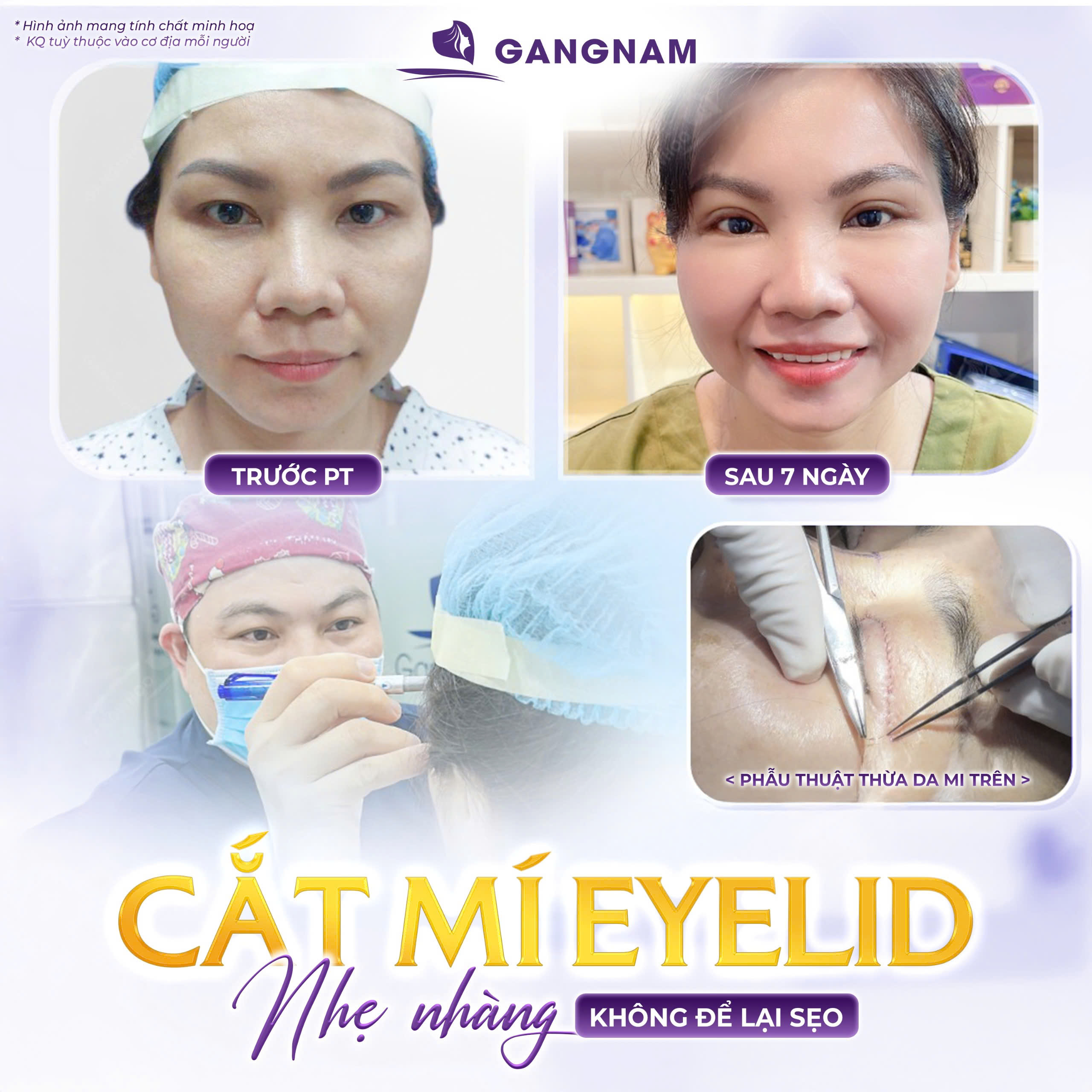 Cắt mí mắt Eyelid – Giải pháp tạo đôi mắt hai mí tự nhiên 4 Tìm hiểu phương pháp cắt mí mắt Eyelid là gì?