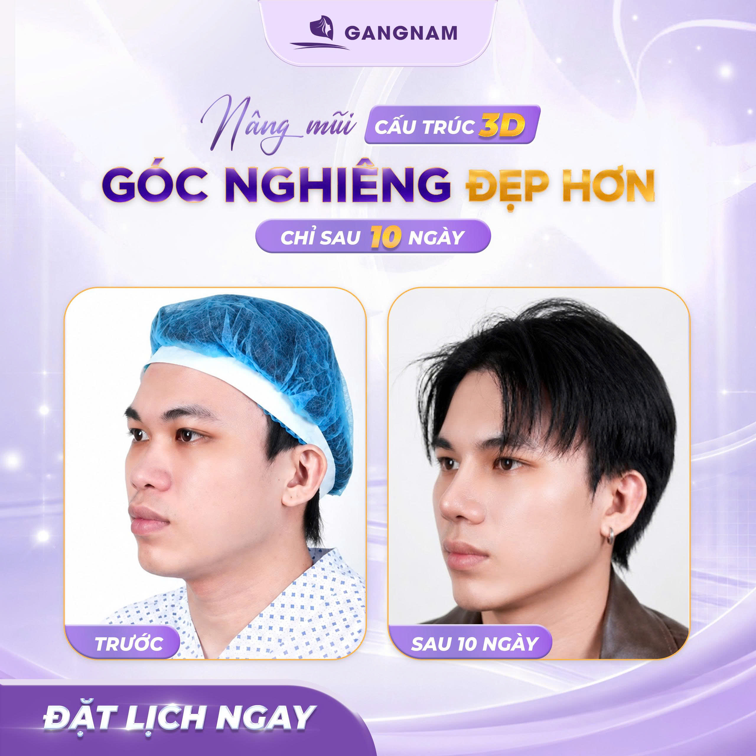 Nâng mũi công nghệ 3D: Giải pháp đột phá sở hữu dáng mũi tỷ lệ vàng chuẩn xác 5 Nâng mũi công nghệ 3D: Giải pháp đột phá sở hữu dáng mũi tỷ lệ vàng chuẩn xác 2