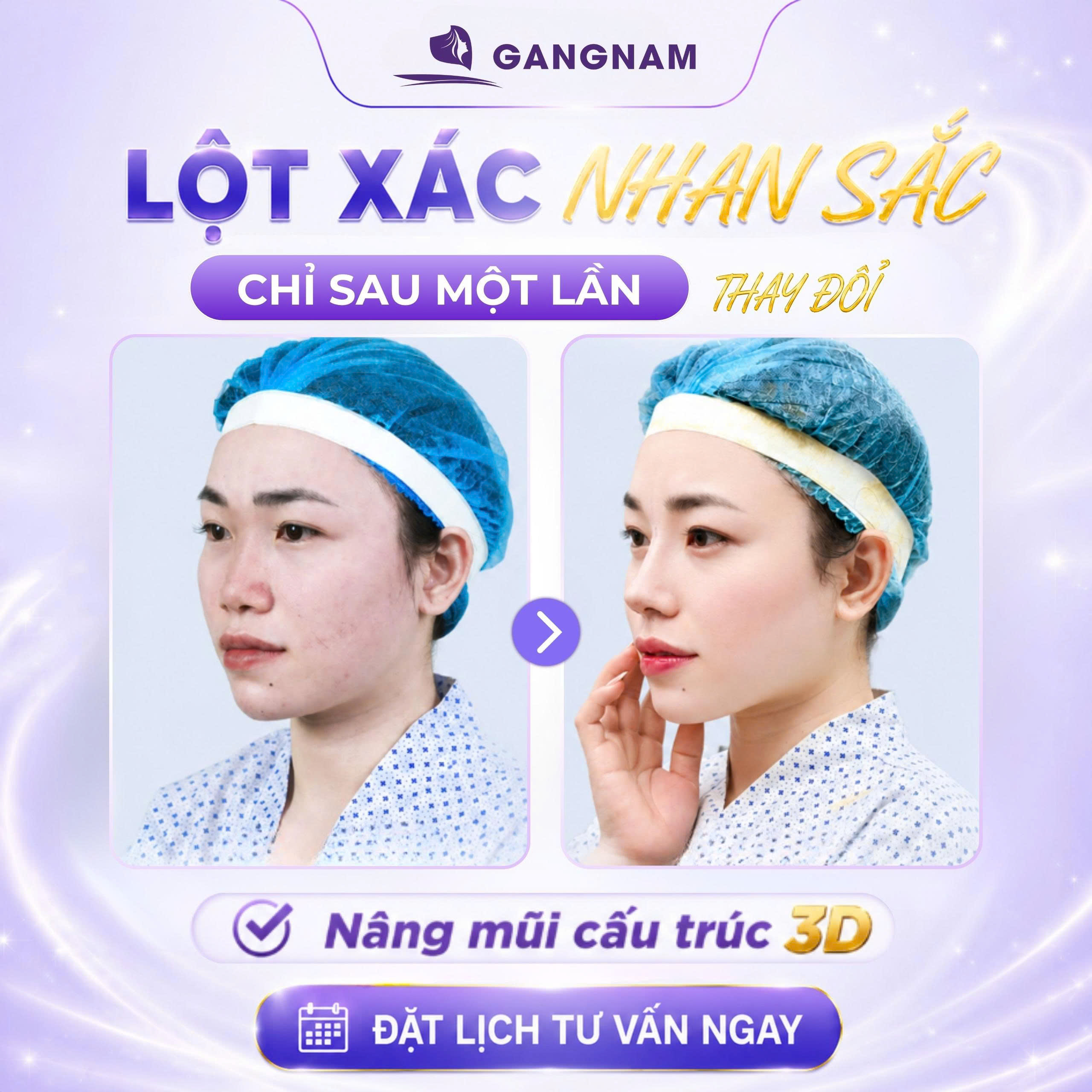 Nâng mũi 3D S-Line tự nhiên: Giải pháp kiến tạo dáng mũi thanh tú chuẩn tỷ lệ vàng 4 Công nghệ nâng mũi 3D S-Line tự nhiên là gì?