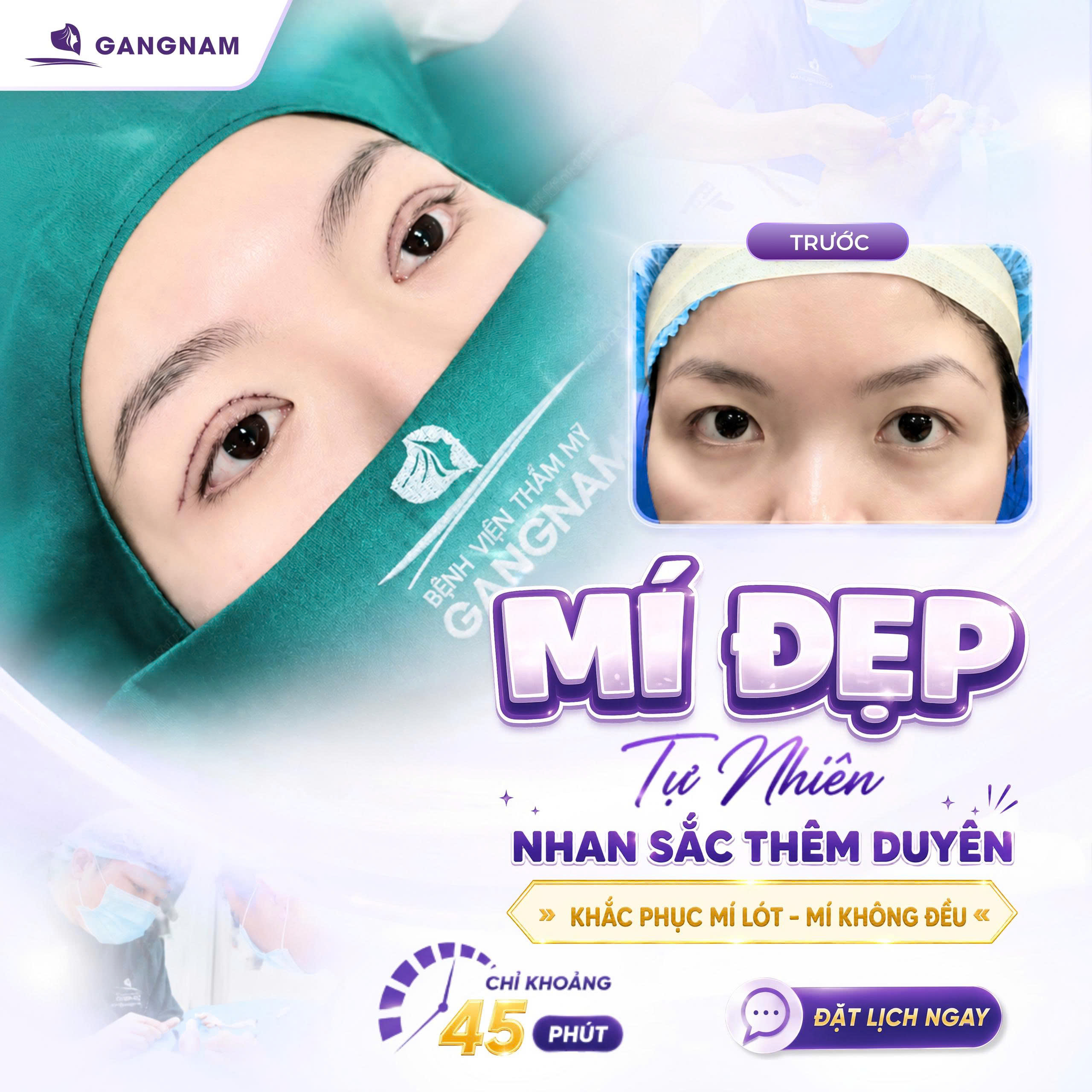 Cắt mí Eyelid lấy mỡ thừa – Giải pháp thẩm mỹ mắt toàn diện và bền vững 4 Cắt mí Eyelid lấy mỡ thừa là gì và cơ chế hoạt động ra sao