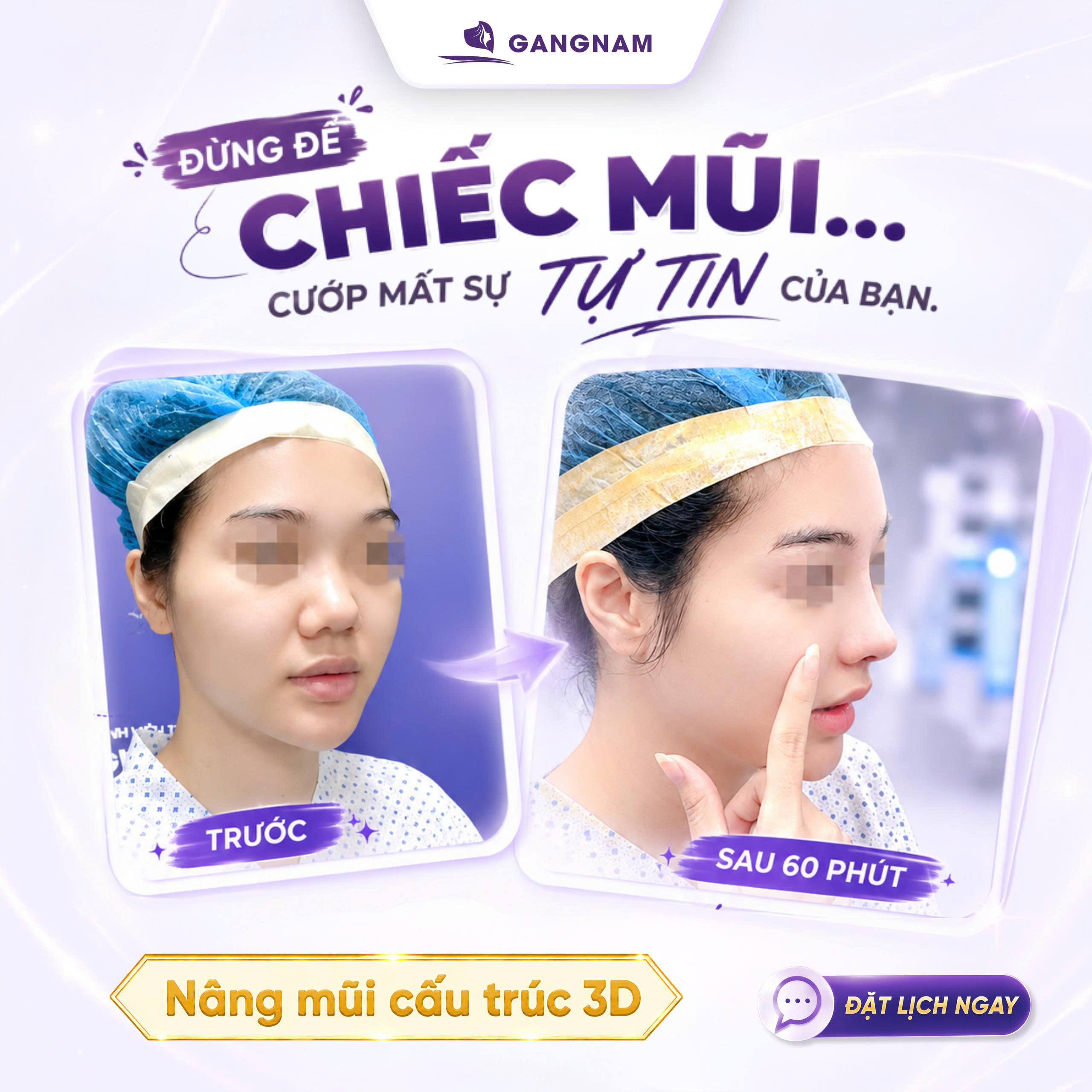 Nâng Mũi Nội Soi 4K Chuẩn Y Khoa: Giải Pháp Tiên Tiến Cho Dáng Mũi Hoàn Hảo 4 Nâng mũi nội soi 4K chuẩn y khoa là gì?