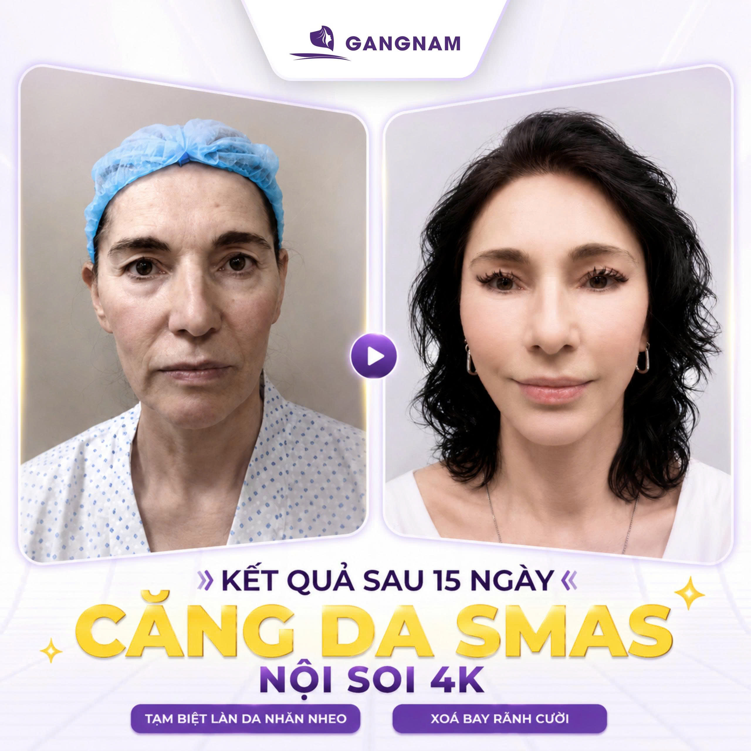 Nâng cơ SMAS nội soi – Giải pháp trẻ hóa da mặt chuyên sâu 6 Nâng cơ SMAS nội soi tại Thẩm mỹ Gangnam