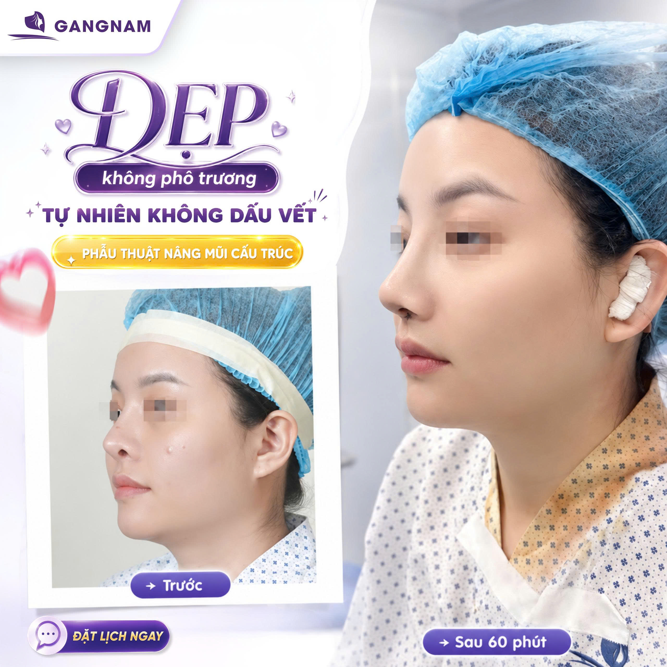 Nâng mũi cấu trúc 3D S-Line – Bí quyết sở hữu dáng mũi hoàn hảo theo tiêu chuẩn Á Đông 4 Tổng quan về nâng mũi cấu trúc 3D S-Line