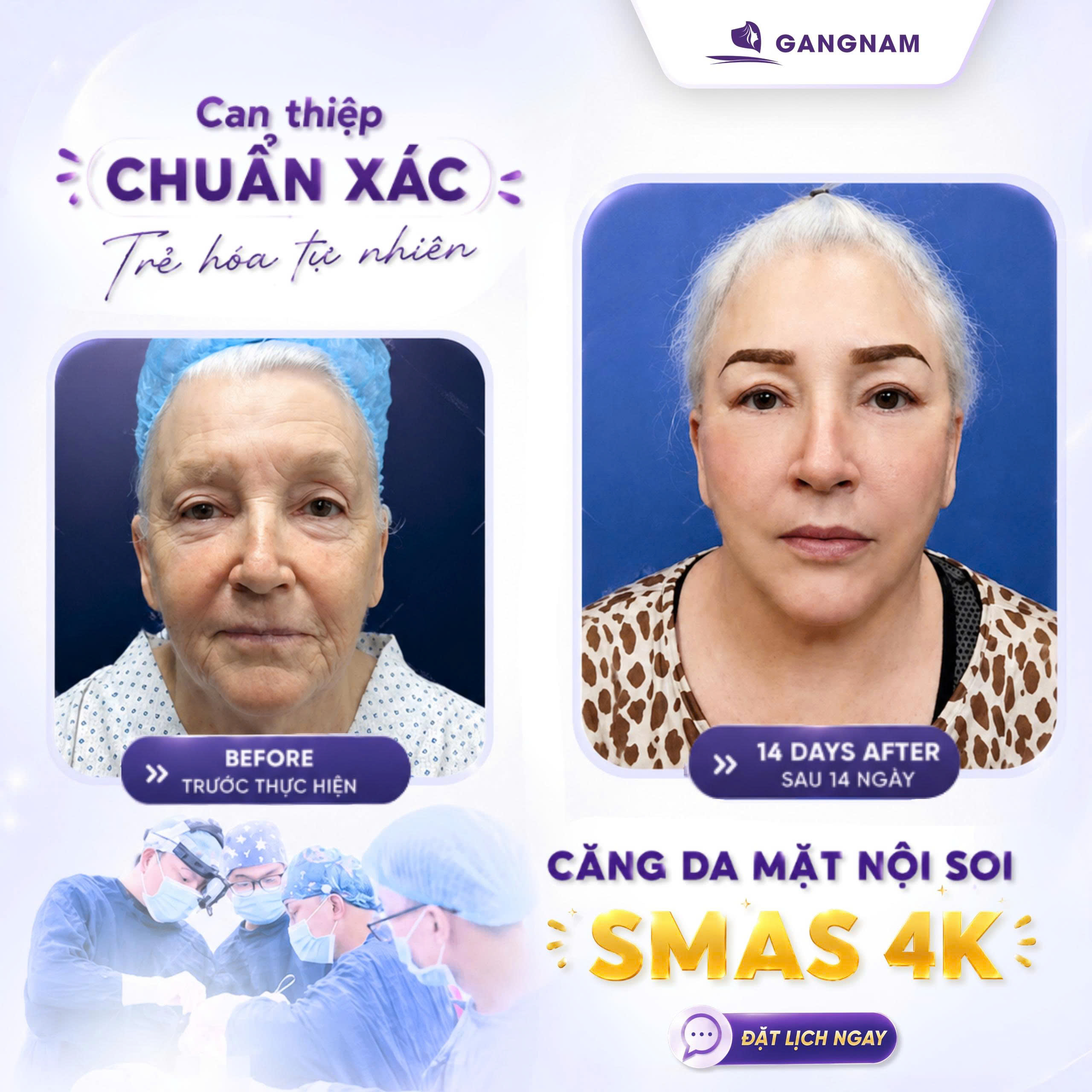 Nâng cơ SMAS nội soi – Giải pháp trẻ hóa da mặt chuyên sâu 4 Nâng cơ SMAS nội soi là gì?