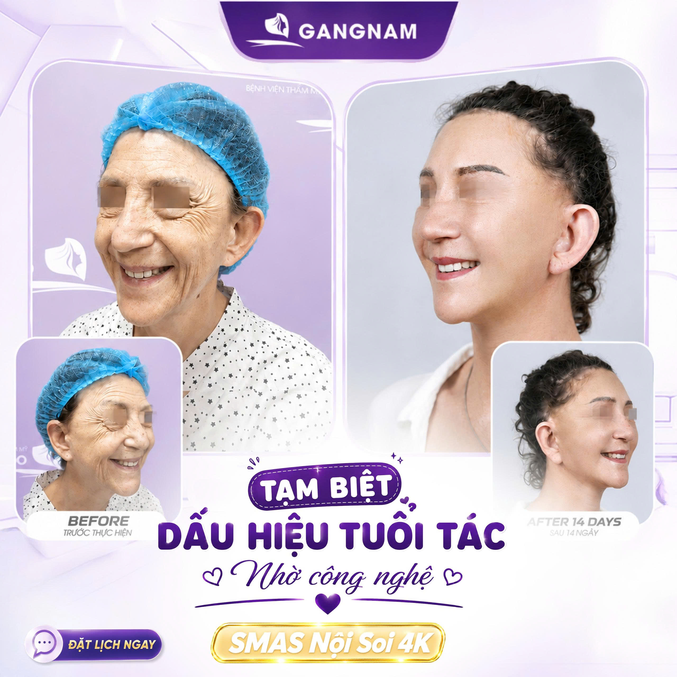 Nâng cơ mặt SMAS nội soi 4K – Giải pháp trẻ hóa toàn diện và tự nhiên 5 Nâng cơ mặt SMAS nội soi 4K – Giải pháp trẻ hóa toàn diện và tự nhiên 2