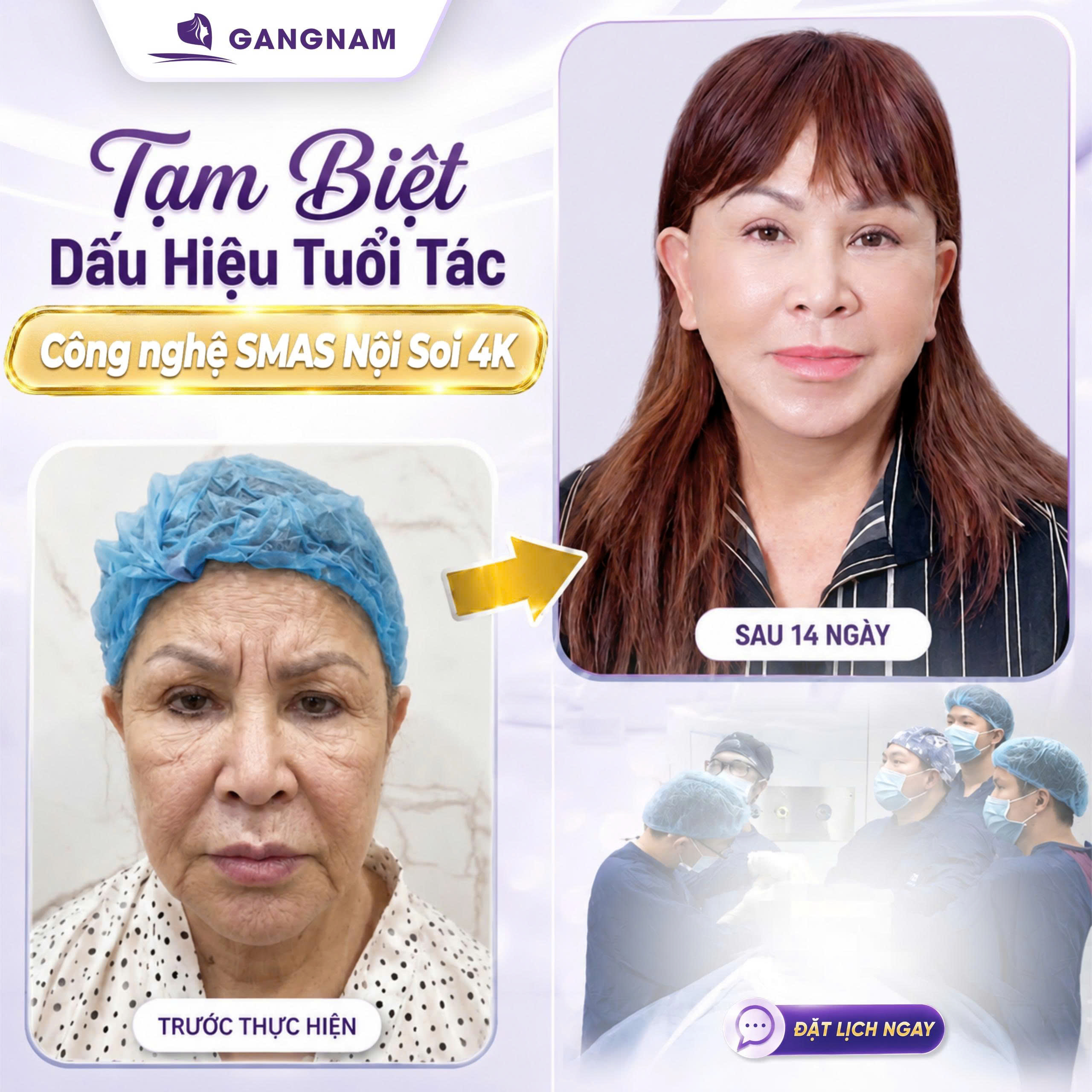 Nâng cơ mặt SMAS nội soi 4K – Giải pháp trẻ hóa toàn diện và tự nhiên 4 Hiểu rõ nâng cơ mặt SMAS nội soi 4K là gì?