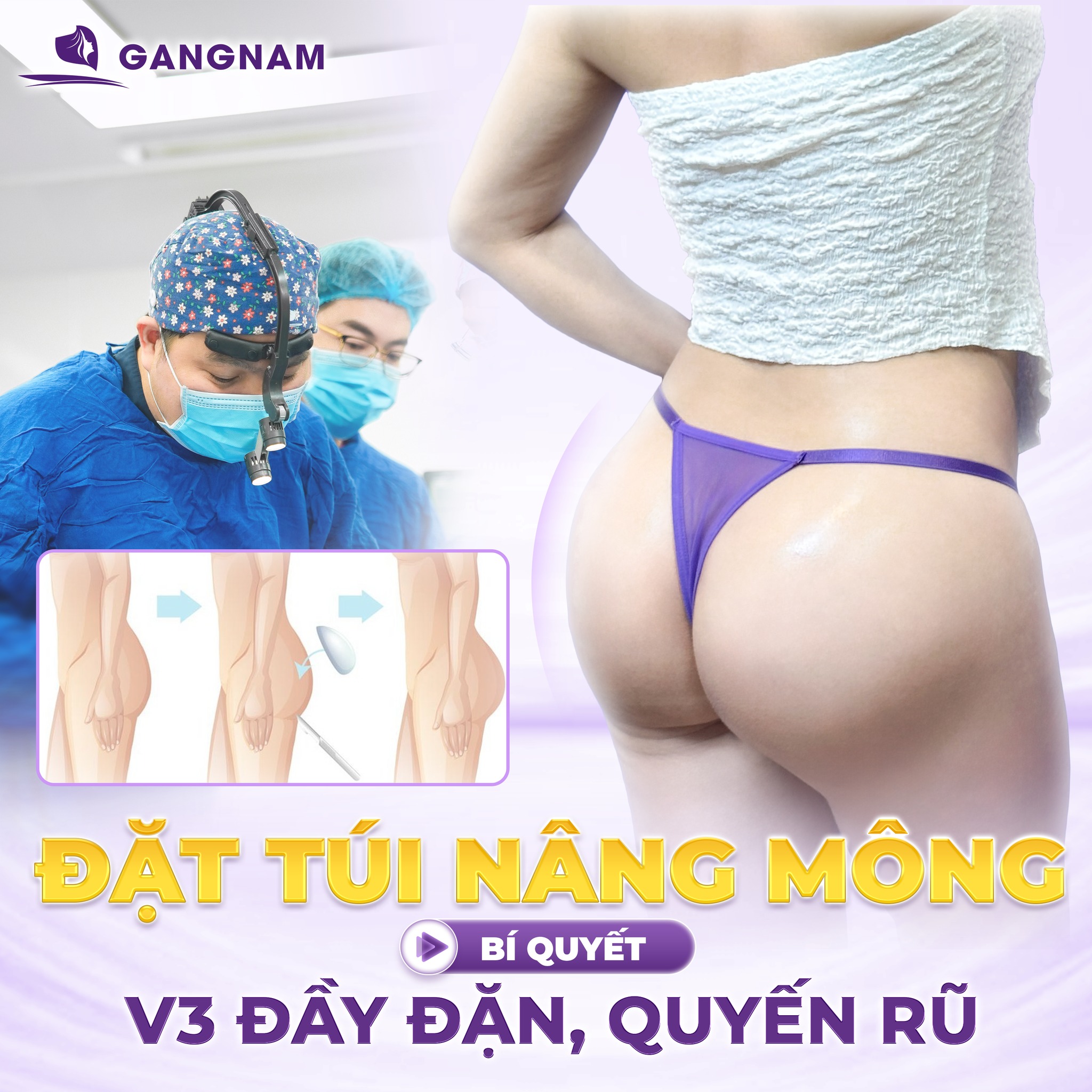 Nâng mông bằng túi độn silicon: giải pháp hoàn hảo cho vòng 3 quyến rũ và bền vững 4 Tổng quan về nâng mông bằng túi độn silicon