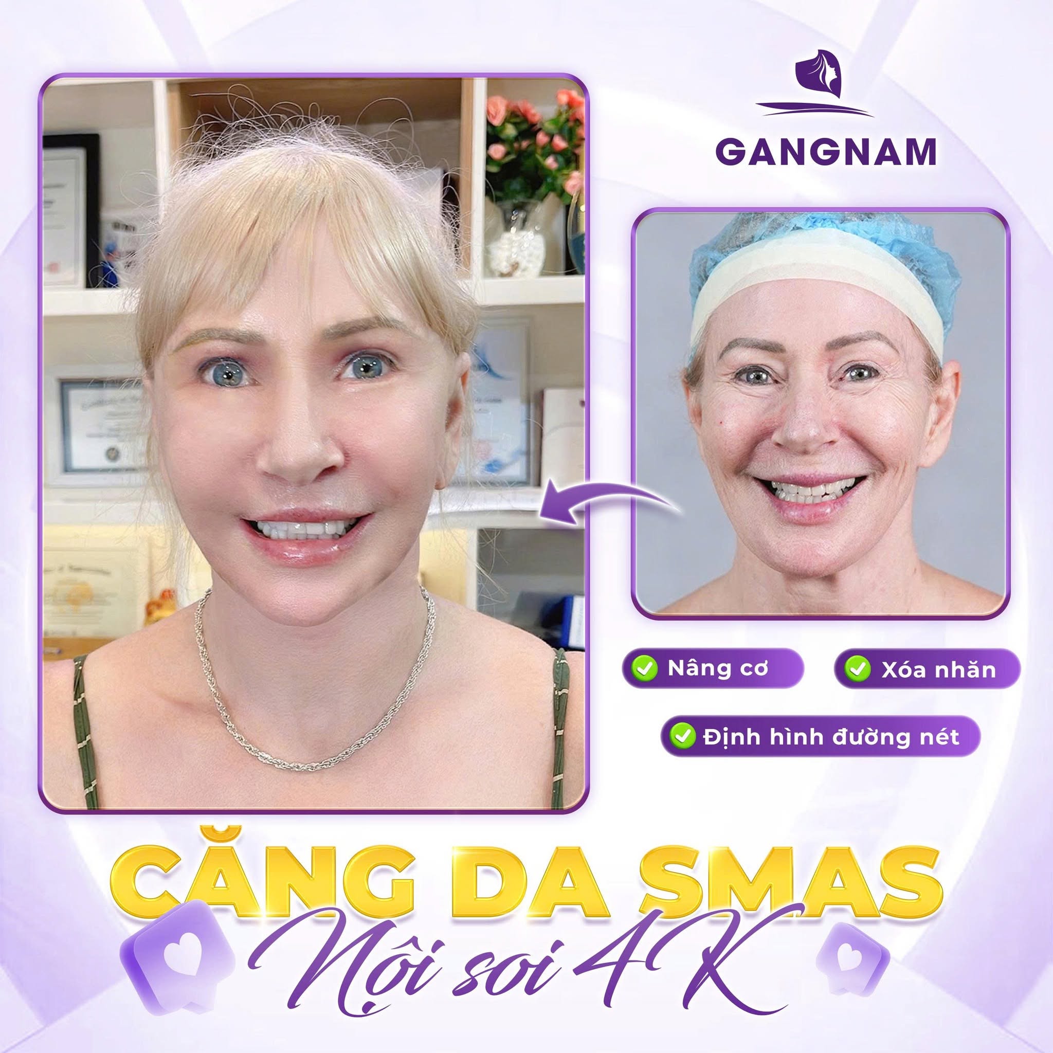 Căng da nội soi công nghệ 4K – Giải pháp trẻ hóa khuôn mặt chính xác và an toàn 6 Căng da nội soi công nghệ 4K tại Thẩm mỹ Gangnam