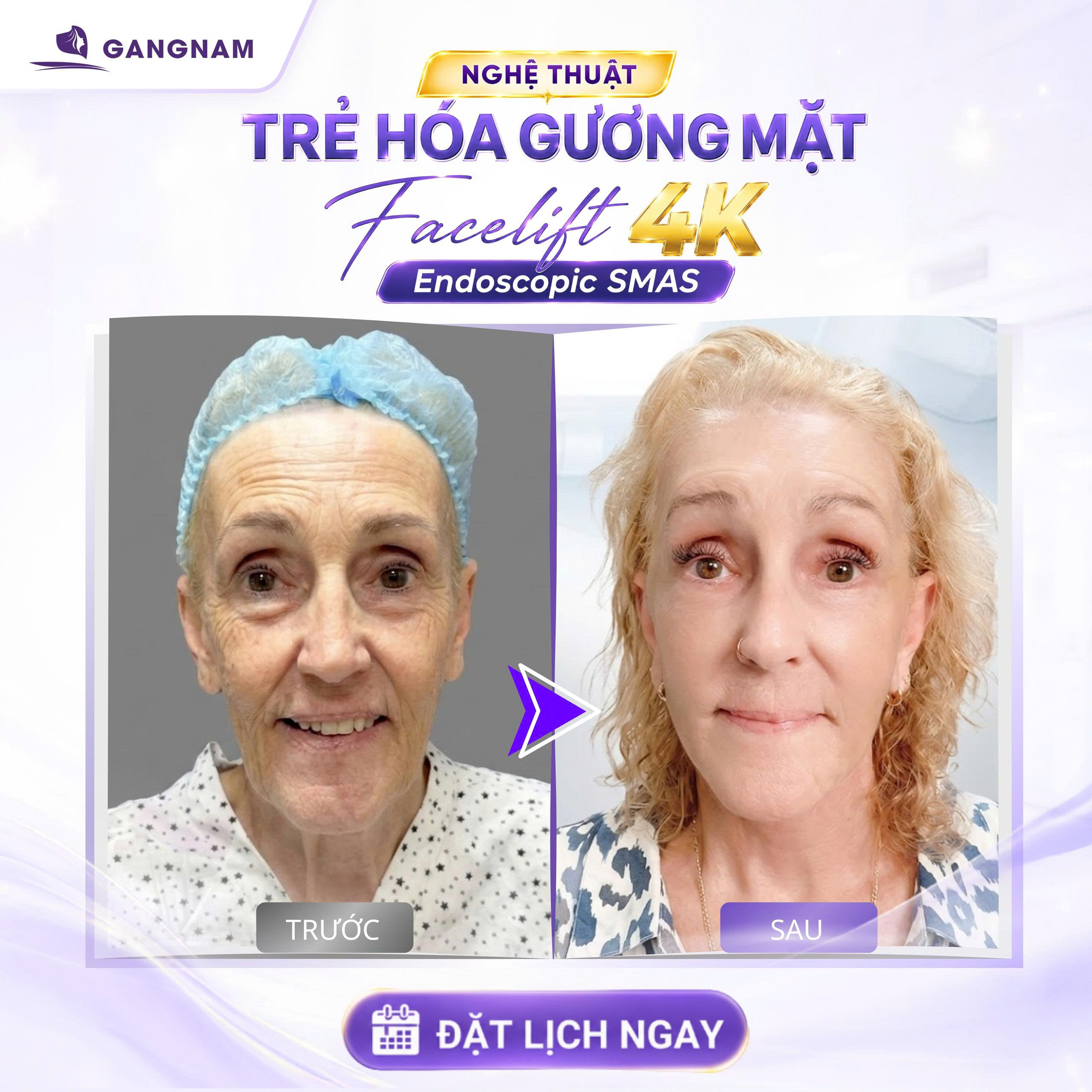 Căng Da Mặt Nội Soi Trẻ Hóa: Giải Pháp Tiên Tiến Cho Gương Mặt Thanh Xuân 6 Căng da mặt nội soi trẻ hóa tại Thẩm mỹ Gangnam