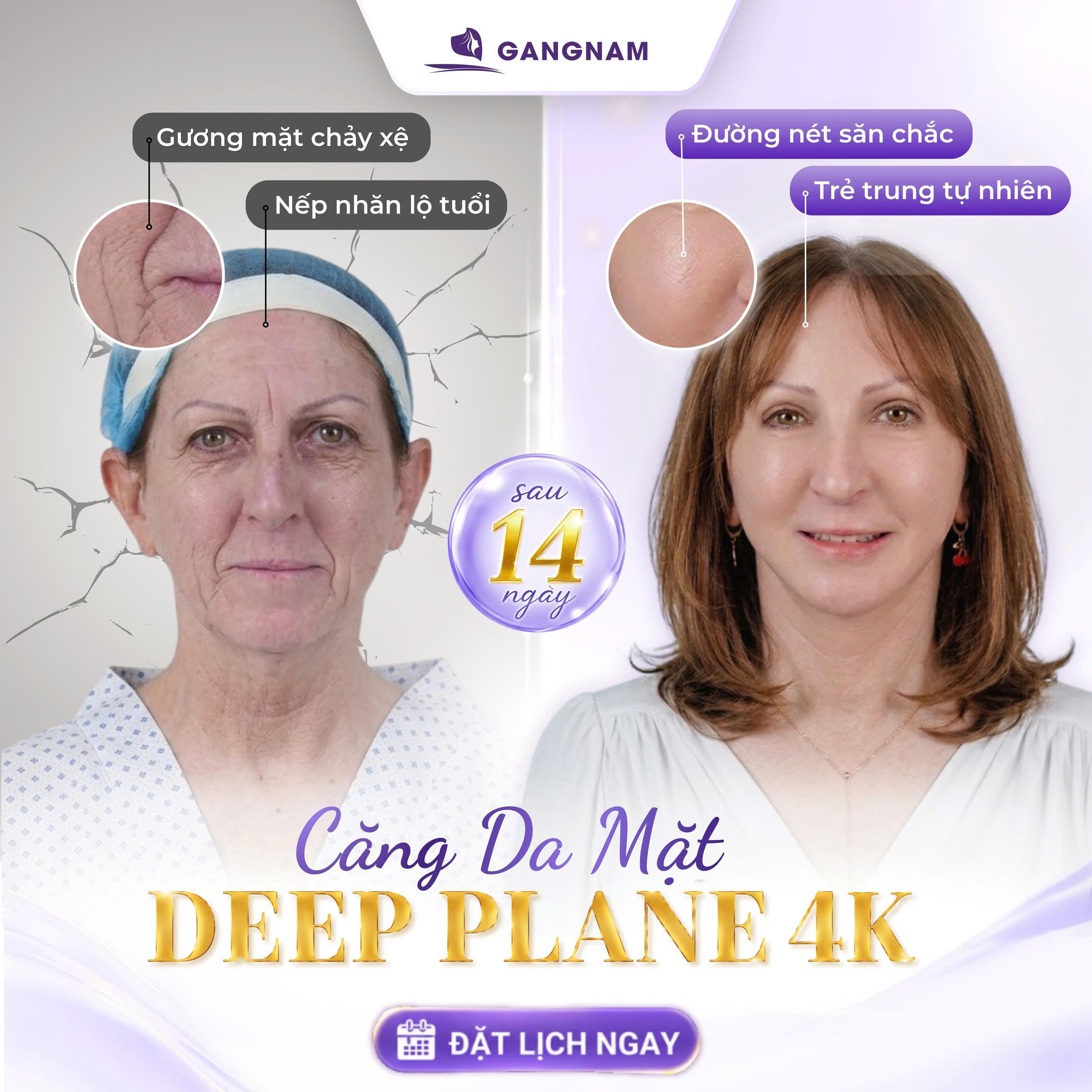 Căng Da Mặt Nội Soi Trẻ Hóa: Giải Pháp Tiên Tiến Cho Gương Mặt Thanh Xuân 4 Căng da mặt nội soi trẻ hóa là gì?