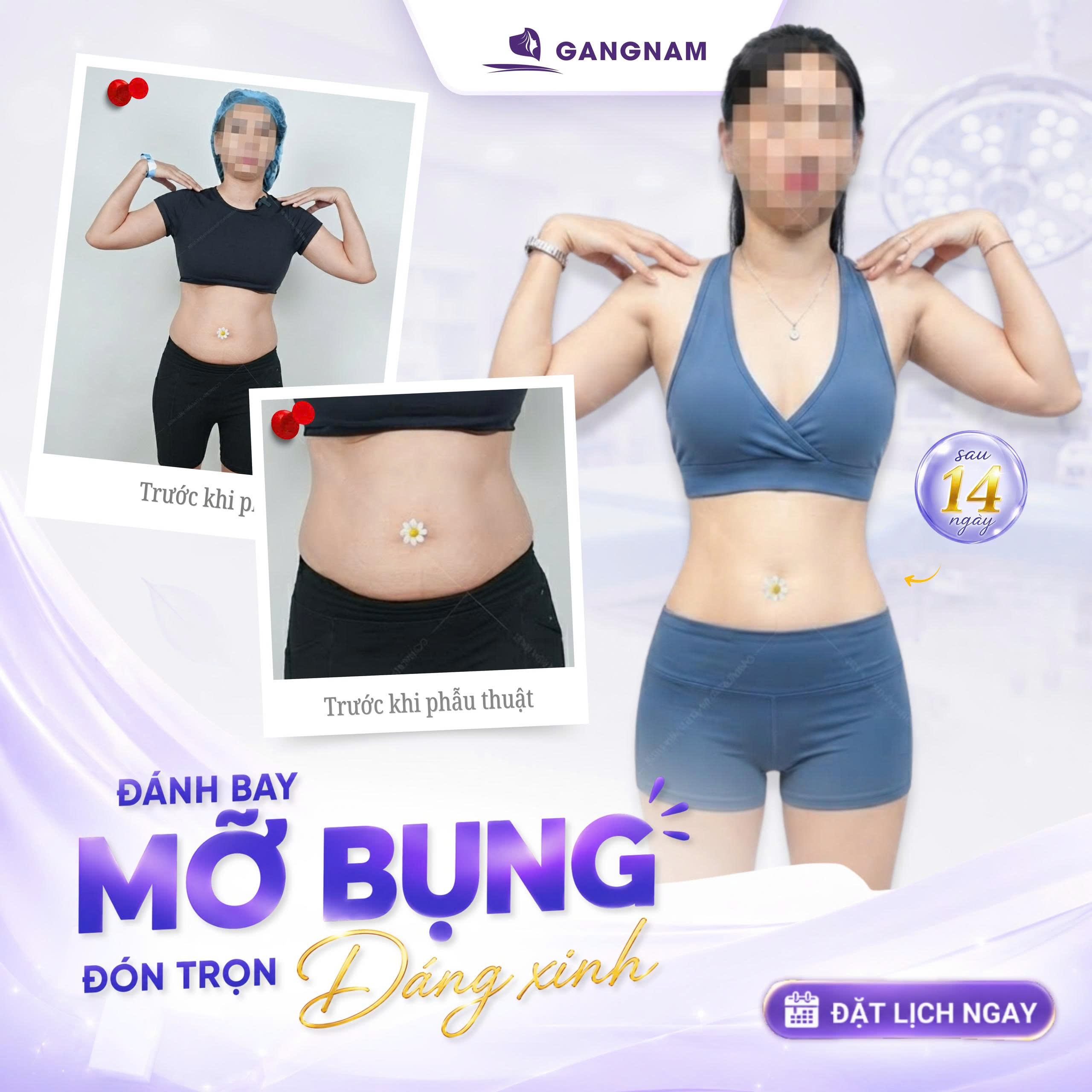 Hút mỡ vòng eo Lipo Ultrasound chuẩn y khoa: Giải pháp định hình vóc dáng hiện đại 5 Hút mỡ vòng eo Lipo Ultrasound chuẩn y khoa: Giải pháp định hình vóc dáng hiện đại 2