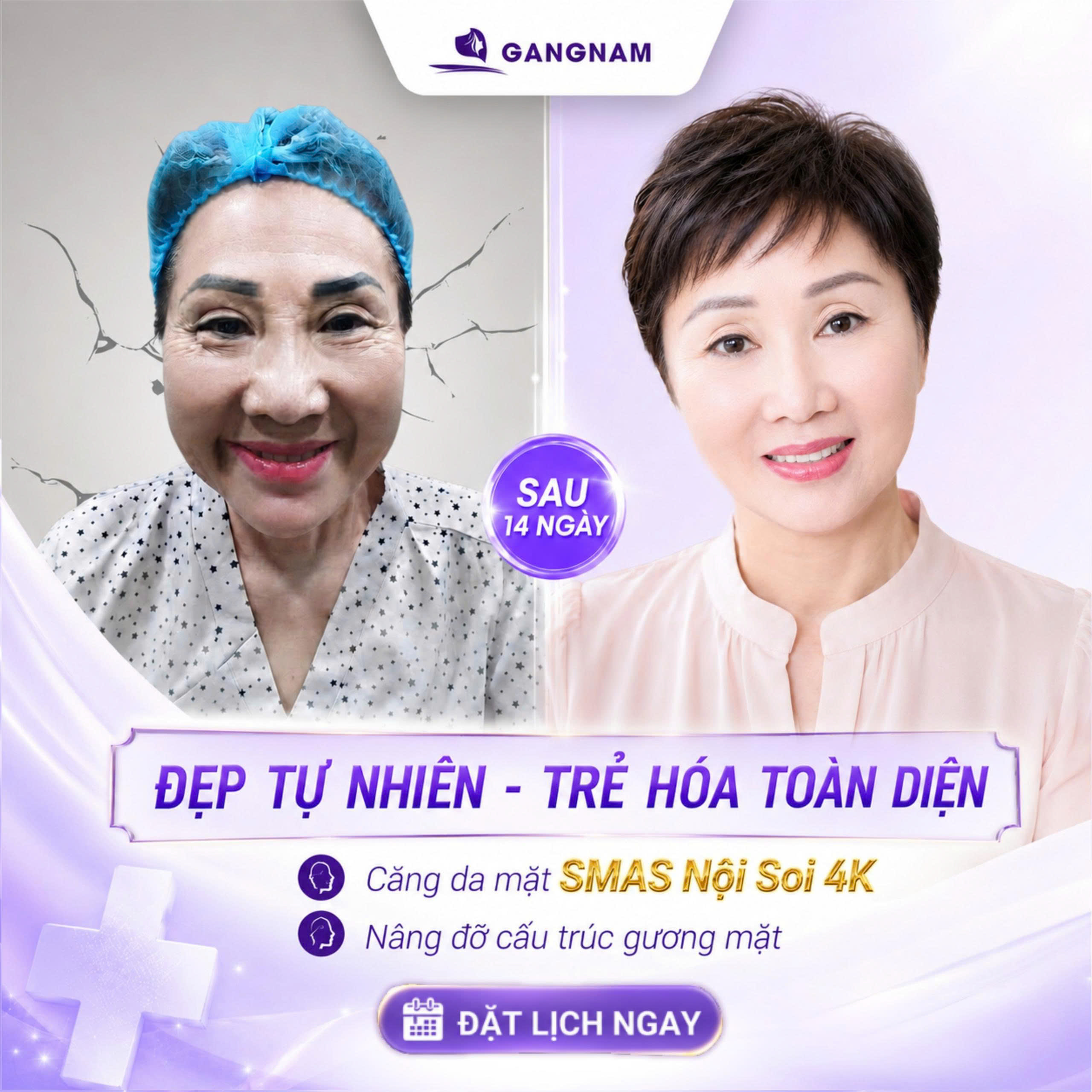 Trẻ hóa SMAS nội soi 4K: Giải pháp trẻ hóa da mặt vượt trội hiện nay 6 Trẻ hóa SMAS nội soi 4K tại Thẩm mỹ Gangnam