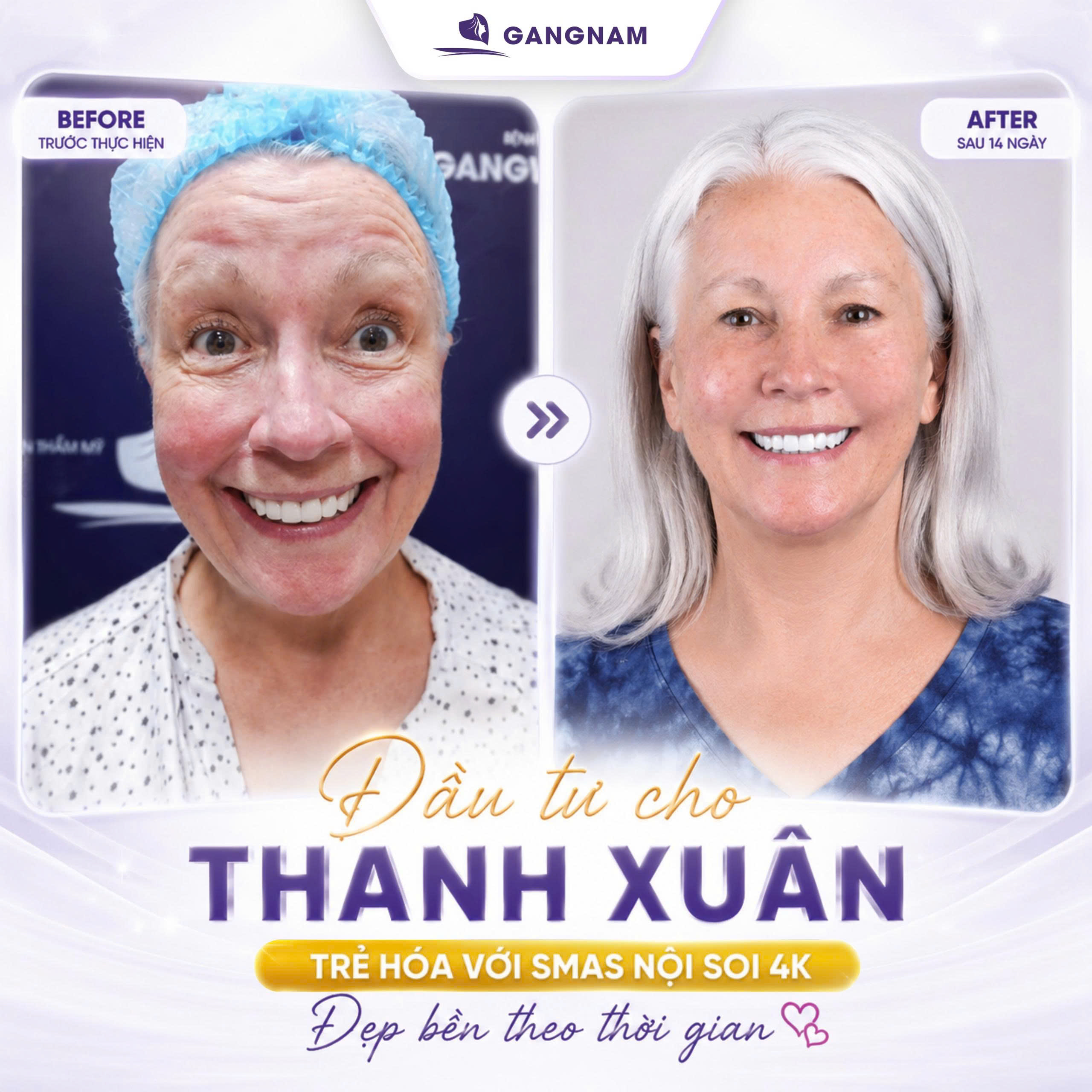 Căng Da Mặt Ở Đâu Uy Tín? Địa Chỉ Trẻ Hóa Được Nhiều Người Quan Tâm 4 Bệnh viện Thẩm mỹ Gangnam – Địa chỉ căng da mặt được nhiều khách hàng quan tâm