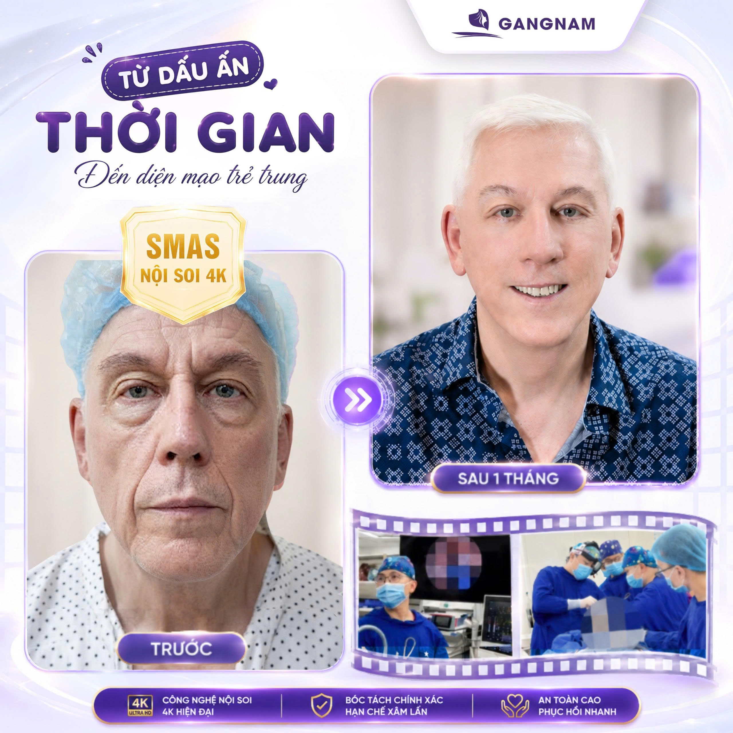 Căng da mặt 4K chuẩn y khoa – Giải pháp trẻ hóa đa tầng toàn diện 6 Căng da mặt 4K chuẩn y khoa – Trẻ hóa đa tầng tại Thẩm mỹ Gangnam