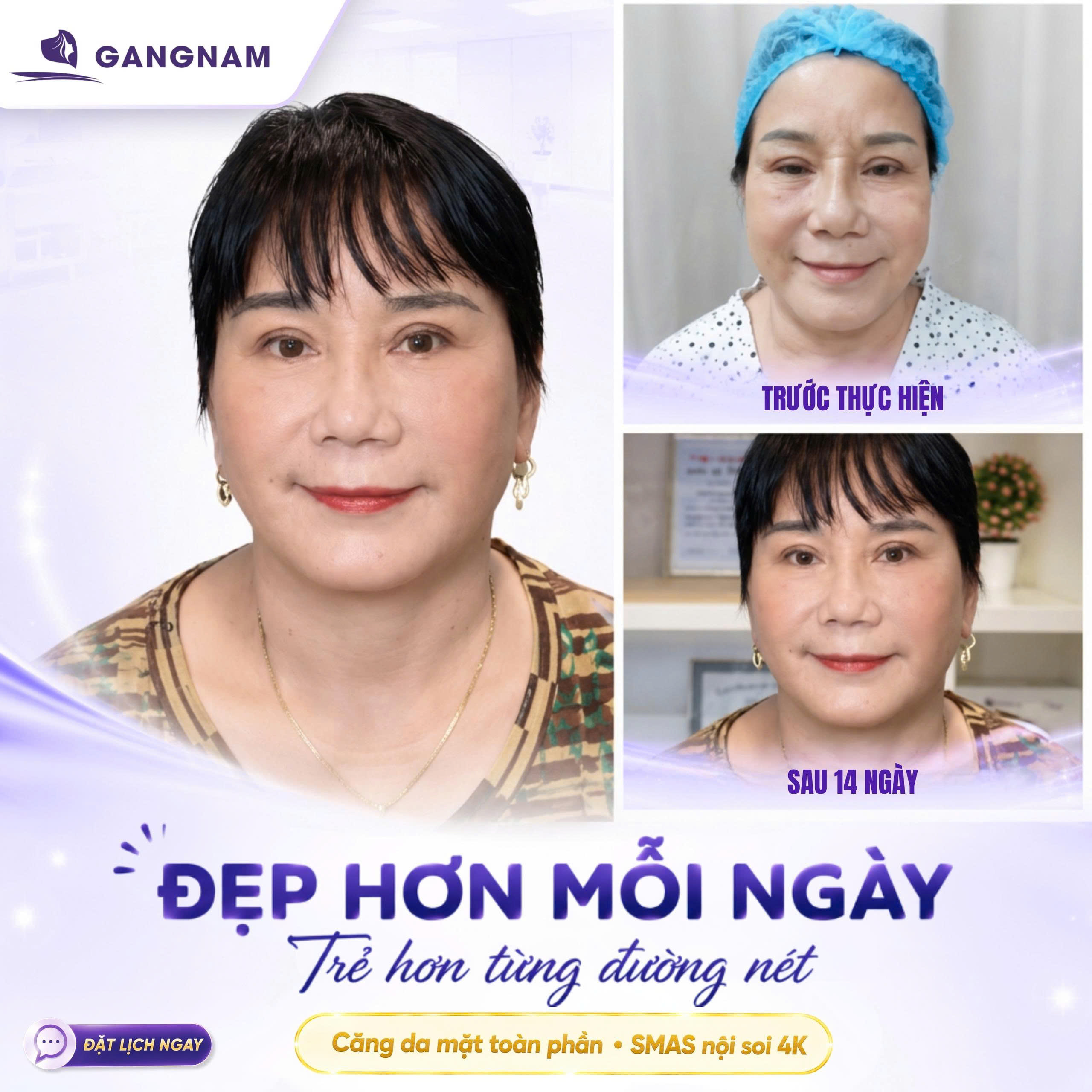 Căng da mặt 4K chuẩn y khoa – Giải pháp trẻ hóa đa tầng toàn diện 4 Căng da mặt 4K chuẩn y khoa là gì và vì sao được ưa chuộng