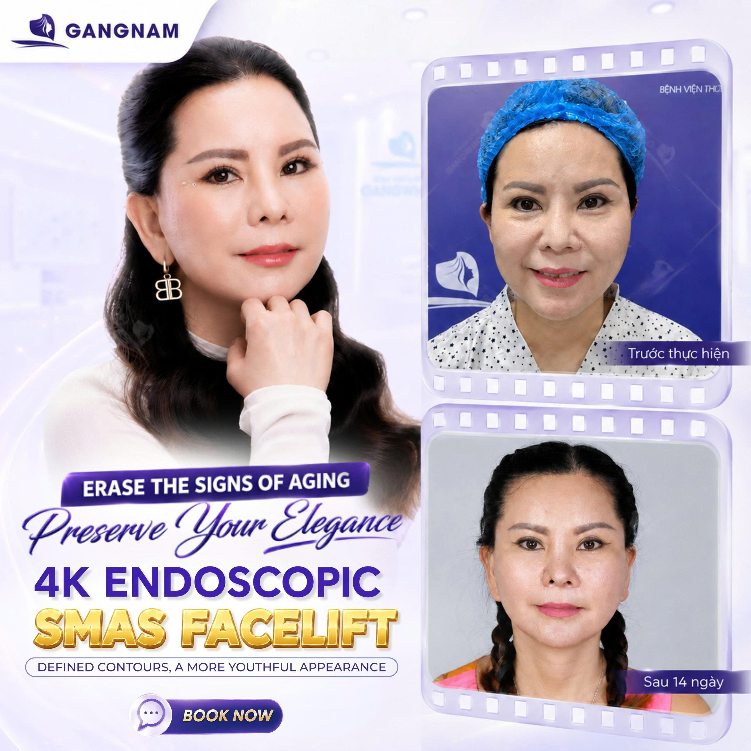 Căng da mặt 4K ít xâm lấn – Giải pháp trẻ hóa hiện đại và an toàn 4 Căng da mặt 4K ít xâm lấn là gì và nguyên lý hoạt động