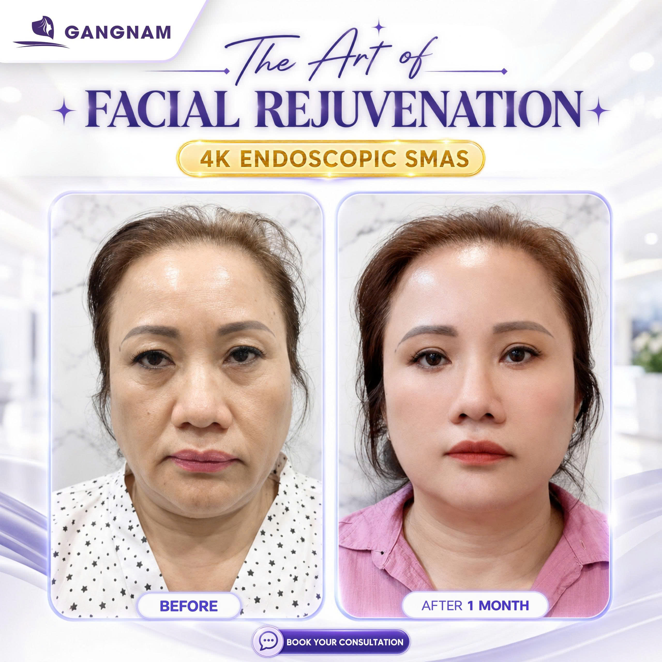 Căng da mặt nội soi hiện đại – Giải pháp trẻ hóa an toàn và tự nhiên 4 Căng da mặt nội soi hiện đại mang lại ưu điểm vượt trội như thế nào