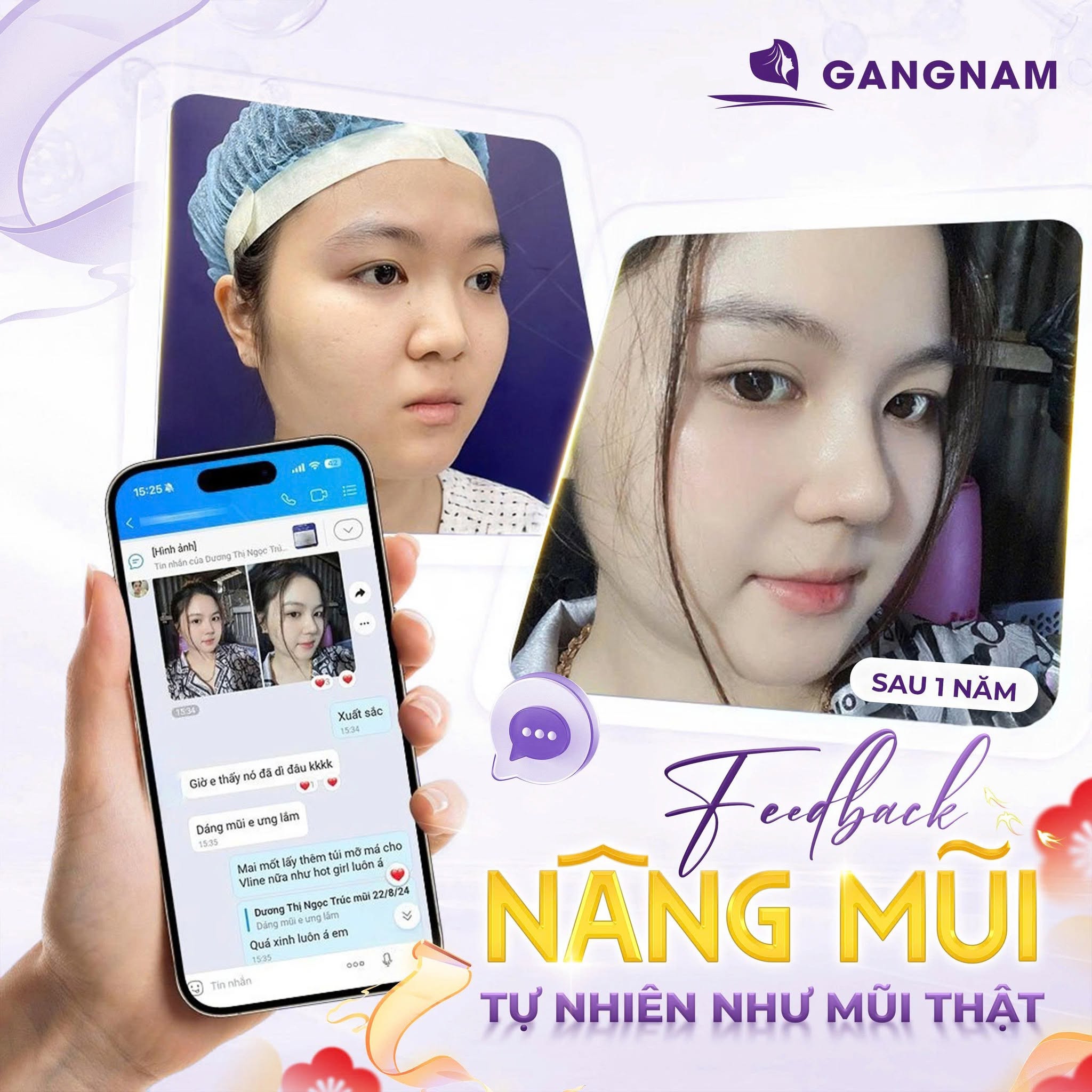 Nâng mũi S-Line chuẩn tỷ lệ – Bí quyết tạo dáng mũi thanh tú hài hòa 4 Nâng mũi S-Line chuẩn tỷ lệ cần đáp ứng những thông số vàng nào