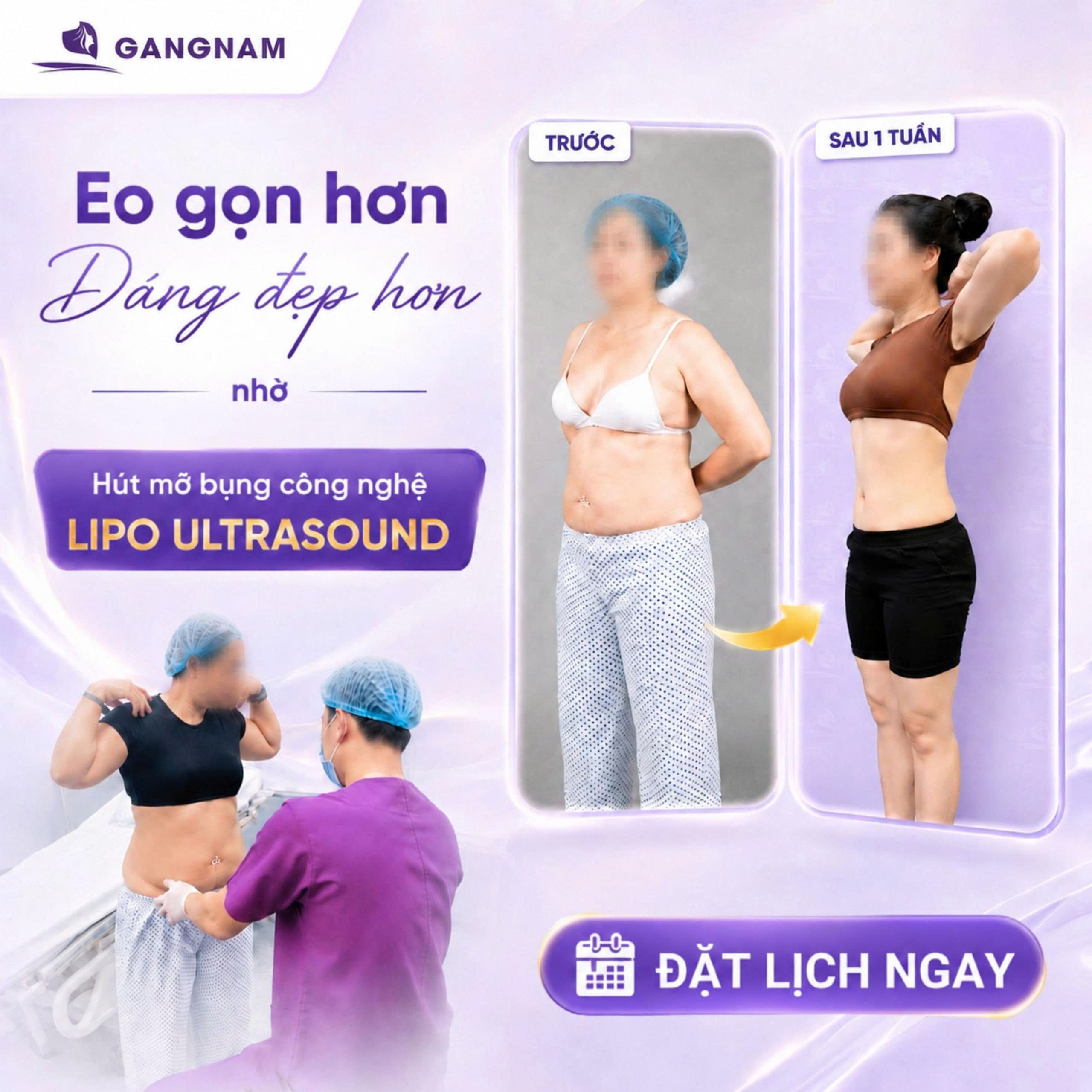 Hút mỡ bụng hiện đại Lipo – Giải pháp định hình vòng eo an toàn và hiệu quả 4 Hút mỡ bụng hiện đại Lipo là gì và vì sao được ưa chuộng