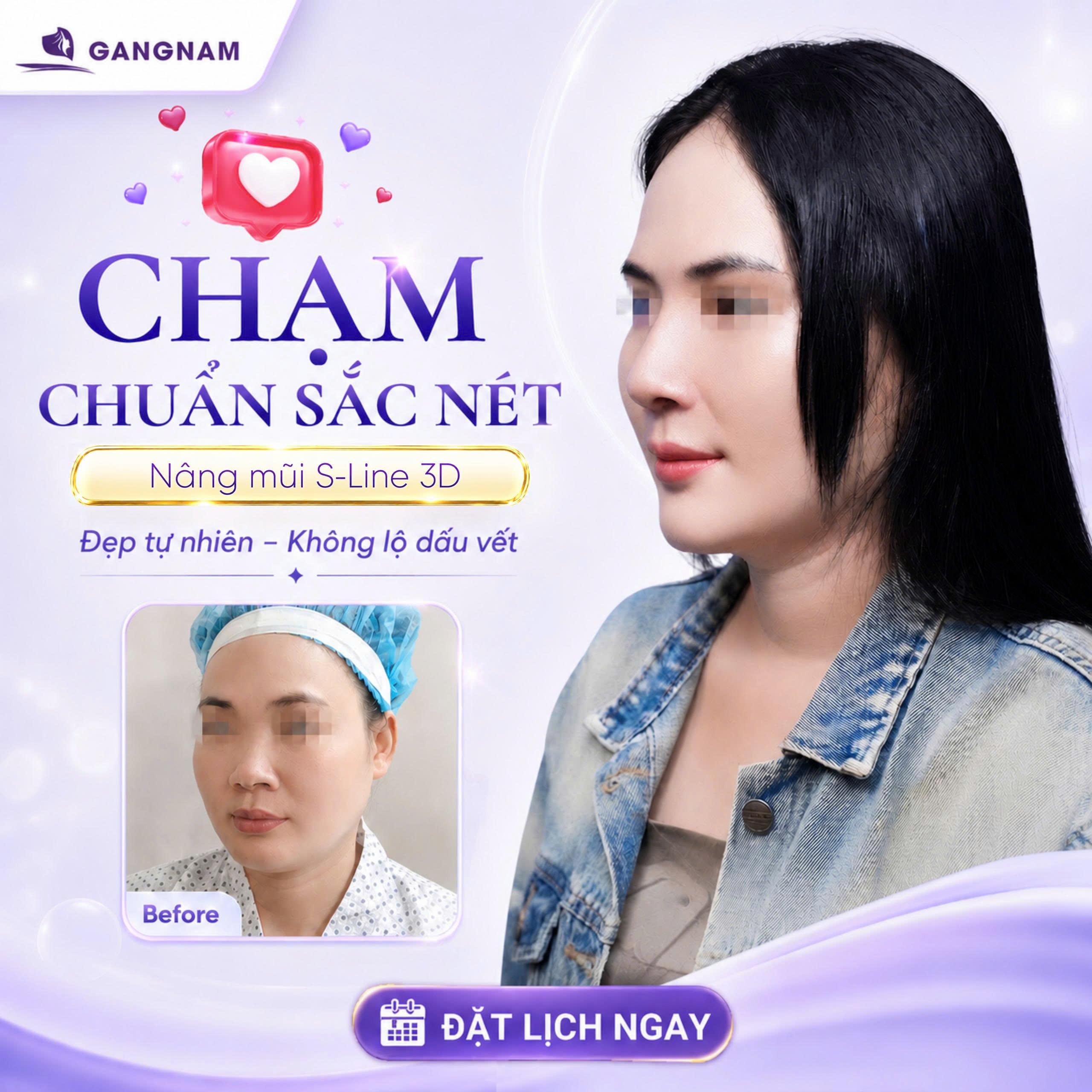 Nâng mũi S-Line chuẩn tỷ lệ – Bí quyết tạo dáng mũi thanh tú hài hòa 5 Nâng mũi S-Line chuẩn tỷ lệ – Bí quyết tạo dáng mũi thanh tú hài hòa 2