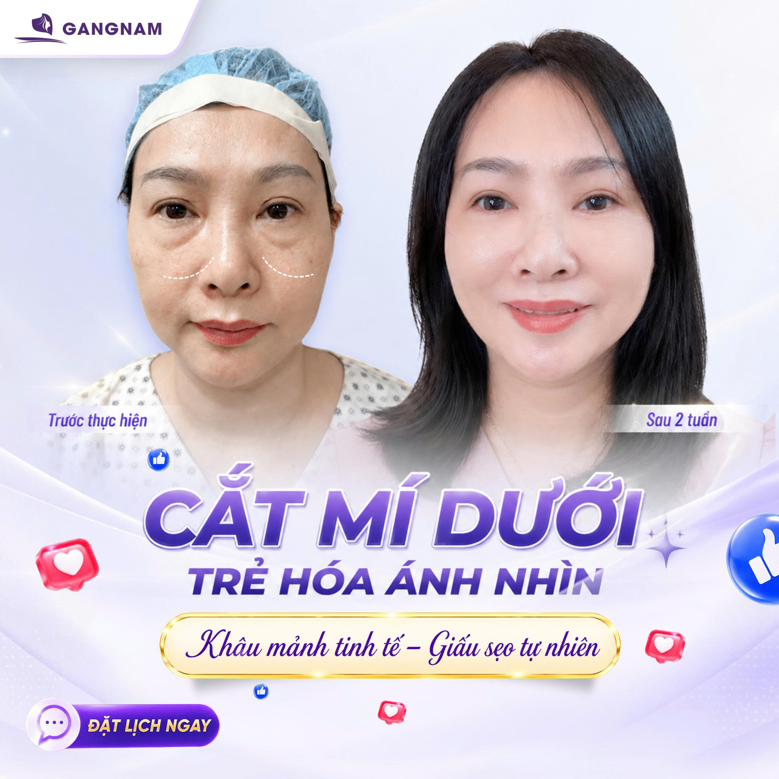 Cắt mí Eyelid 2 mí đẹp – Giải pháp tạo hình mắt tự nhiên và bền vững 4 Cắt mí Eyelid 2 mí đẹp là gì và phù hợp với ai
