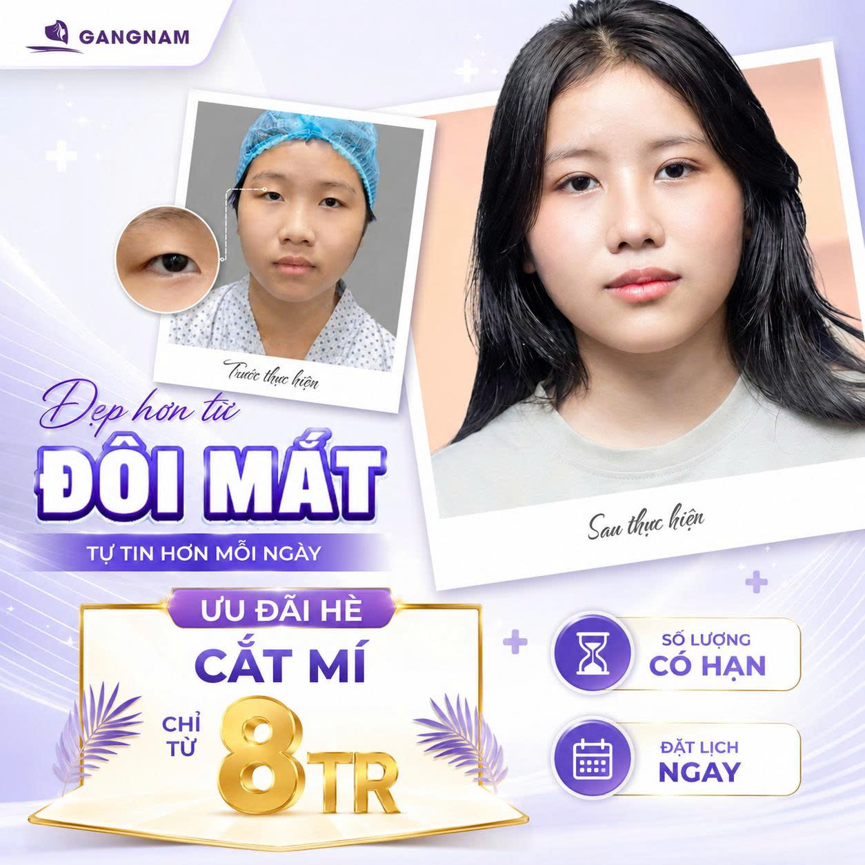 Cắt mí Eyelid 2 mí đẹp – Giải pháp tạo hình mắt tự nhiên và bền vững 6 Cắt mí Eyelid 2 mí đẹp tại Thẩm mỹ Gangnam