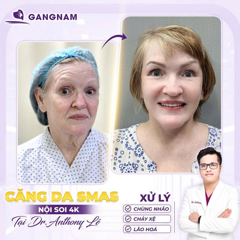 Nâng cơ mặt SMAS nội soi 4K – Giải pháp trẻ hóa toàn diện và tự nhiên 4 Hiểu rõ nâng cơ mặt SMAS nội soi 4K là gì?