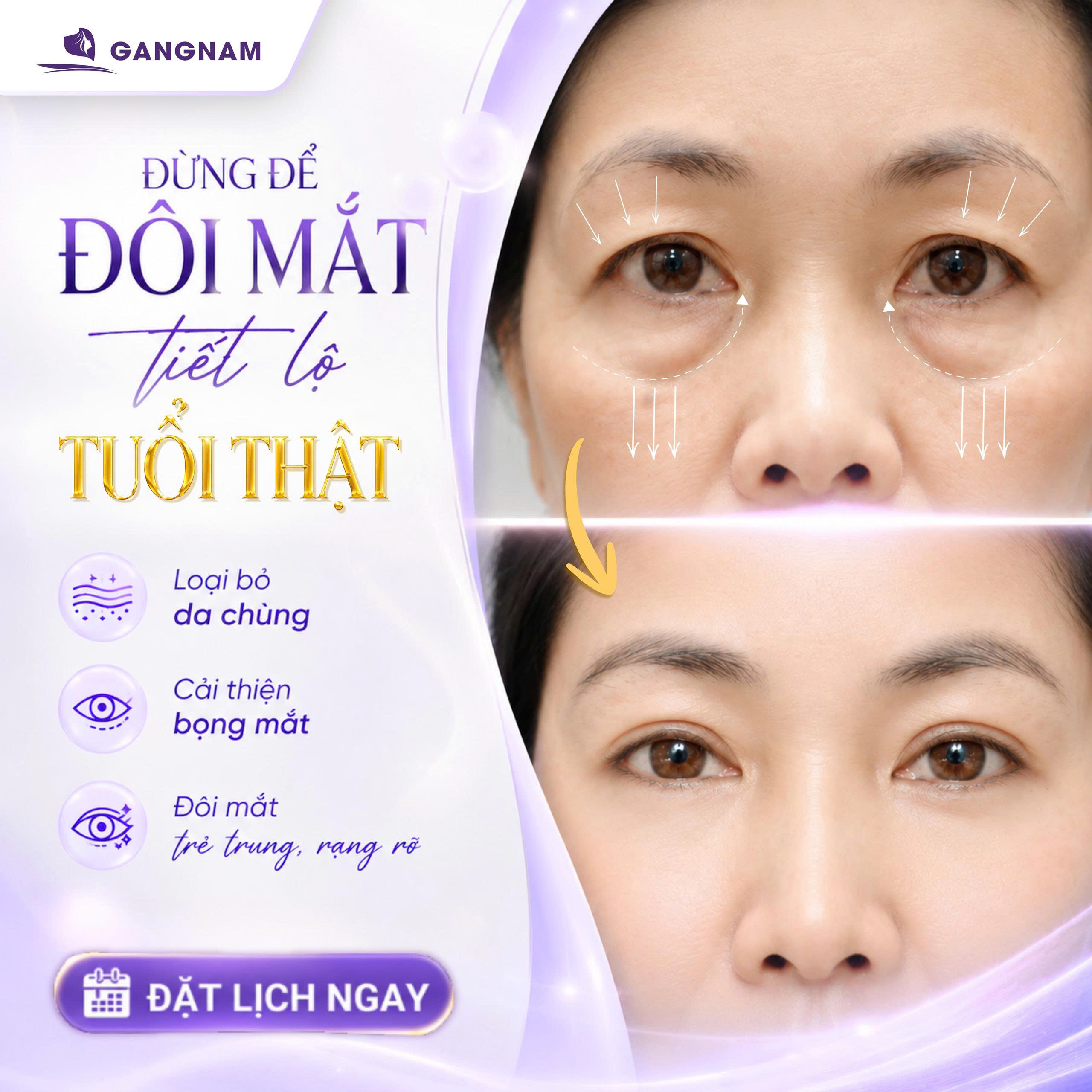 Cắt mí Eyelid tạo mắt hai mí – Giải pháp thẩm mỹ mang lại đôi mắt to tròn tự nhiên 5 Cắt mí Eyelid tạo mắt hai mí – Giải pháp thẩm mỹ mang lại đôi mắt to tròn tự nhiên 2