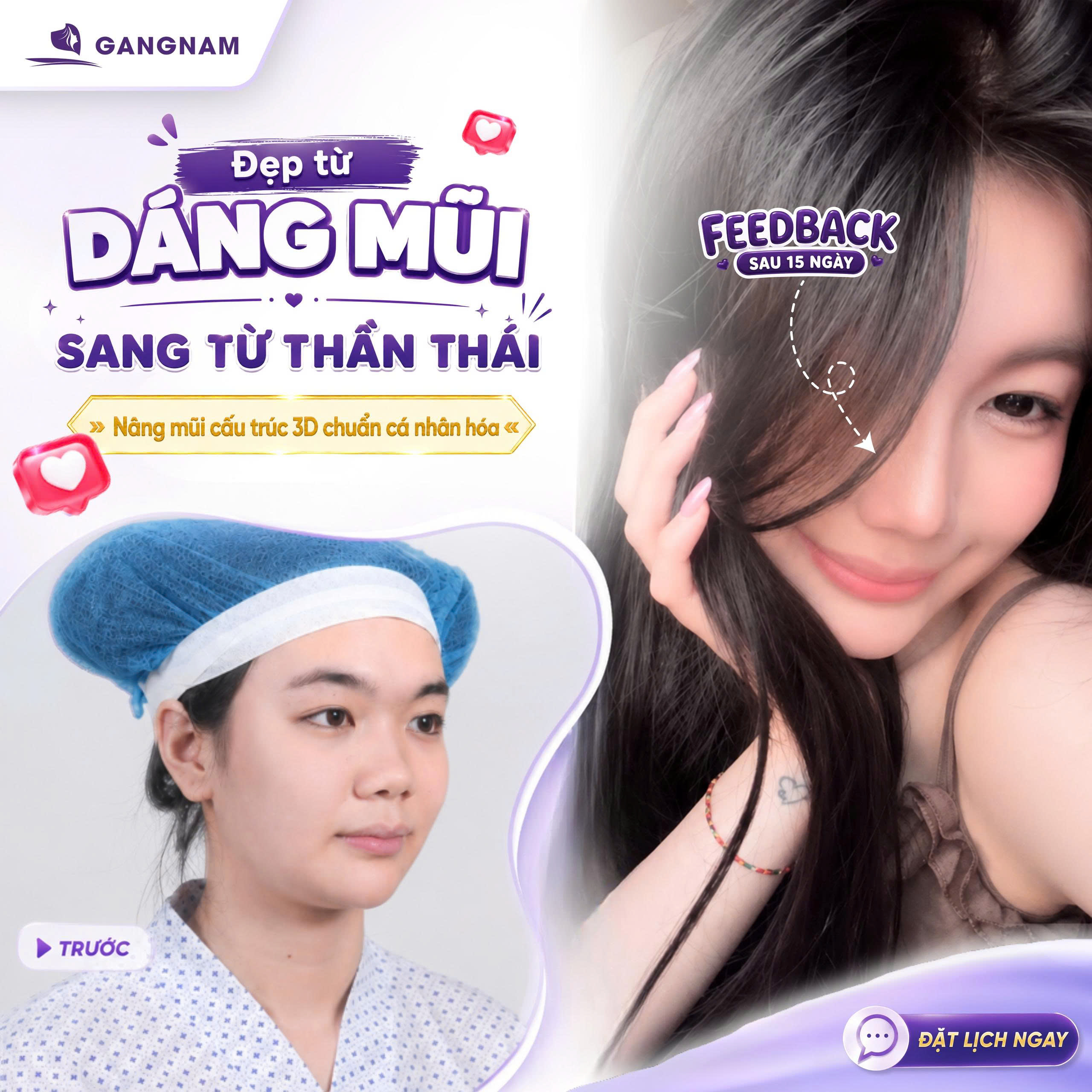 Nâng mũi cấu trúc 3D S-Line – Giải pháp tạo dáng mũi mềm mại và tự nhiên theo chuẩn Đông Á 6 Nâng mũi cấu trúc 3D S-Line tại Thẩm mỹ Gangnam – Hài hòa từng đường nét