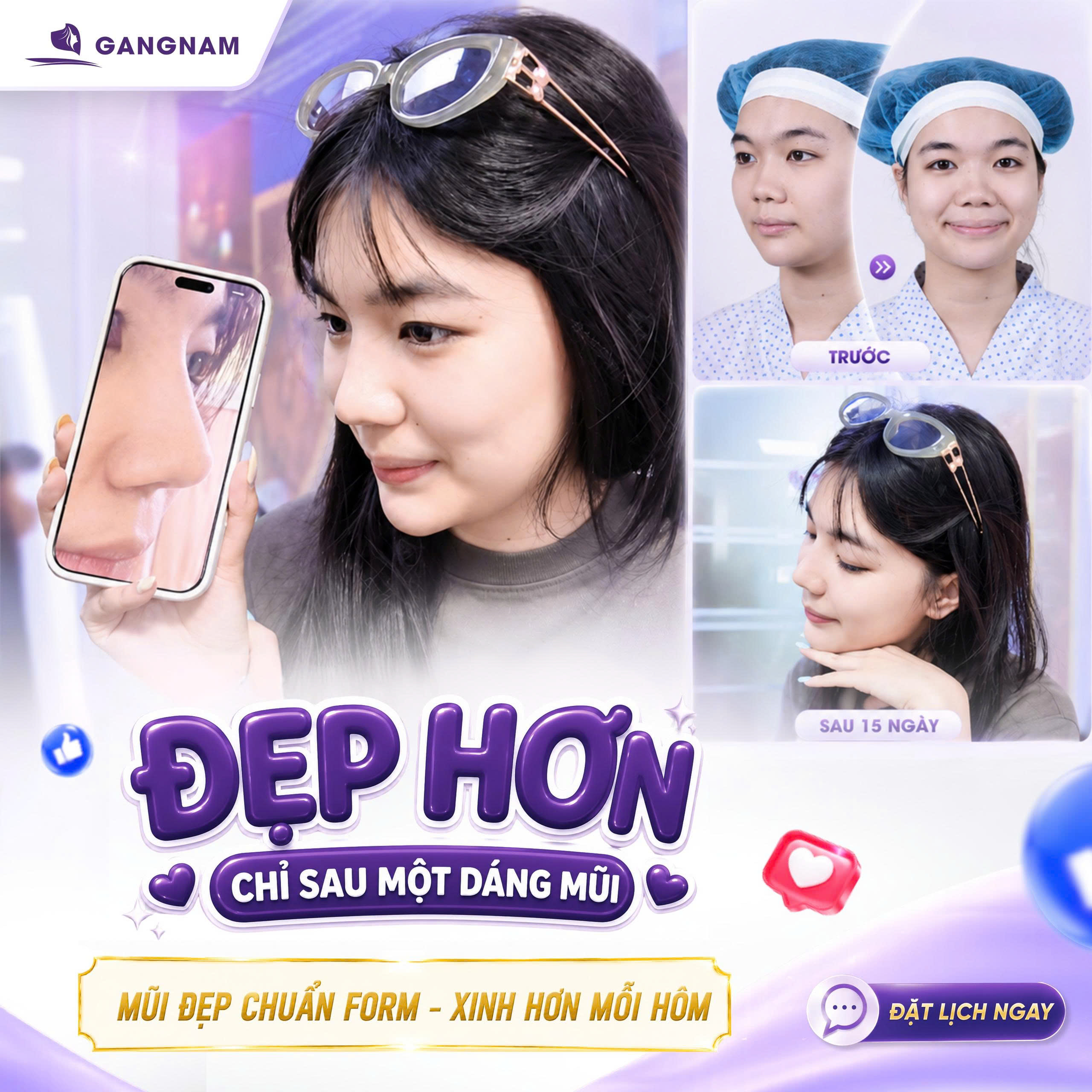 Nâng mũi cấu trúc 3D S-Line – Giải pháp tạo dáng mũi mềm mại và tự nhiên theo chuẩn Đông Á 4 Nâng mũi 3D S-Line là gì và vì sao được ưa chuộng