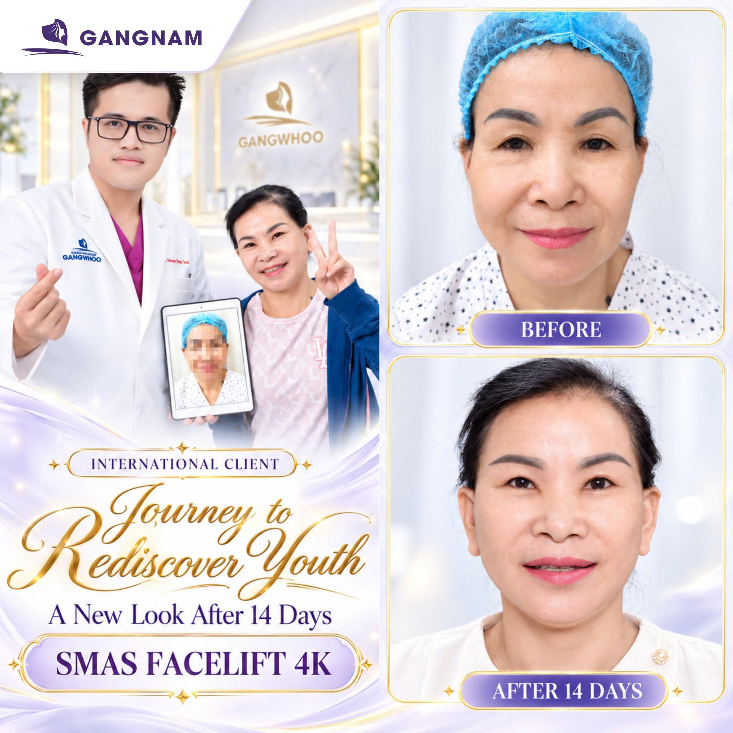 Căng da mặt nội soi ít sưng – Giải pháp trẻ hóa an toàn, tự nhiên và phục hồi nhanh 6 Căng da mặt nội soi ít sưng tại Thẩm mỹ Gangnam