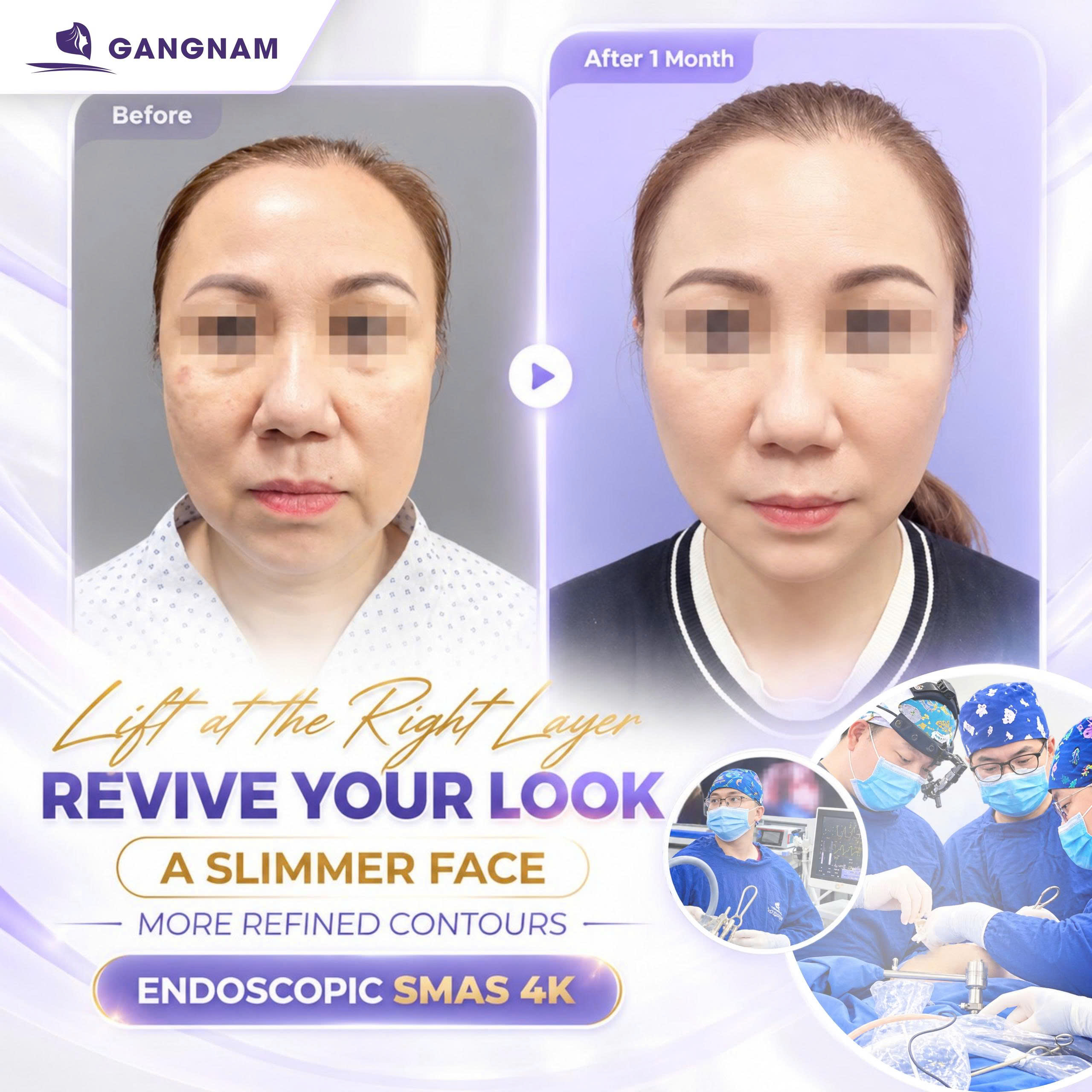 Căng da mặt nội soi là gì? Ưu điểm, quy trình và chi phí 5 Căng da mặt nội soi là gì? Ưu điểm, quy trình và chi phí 3