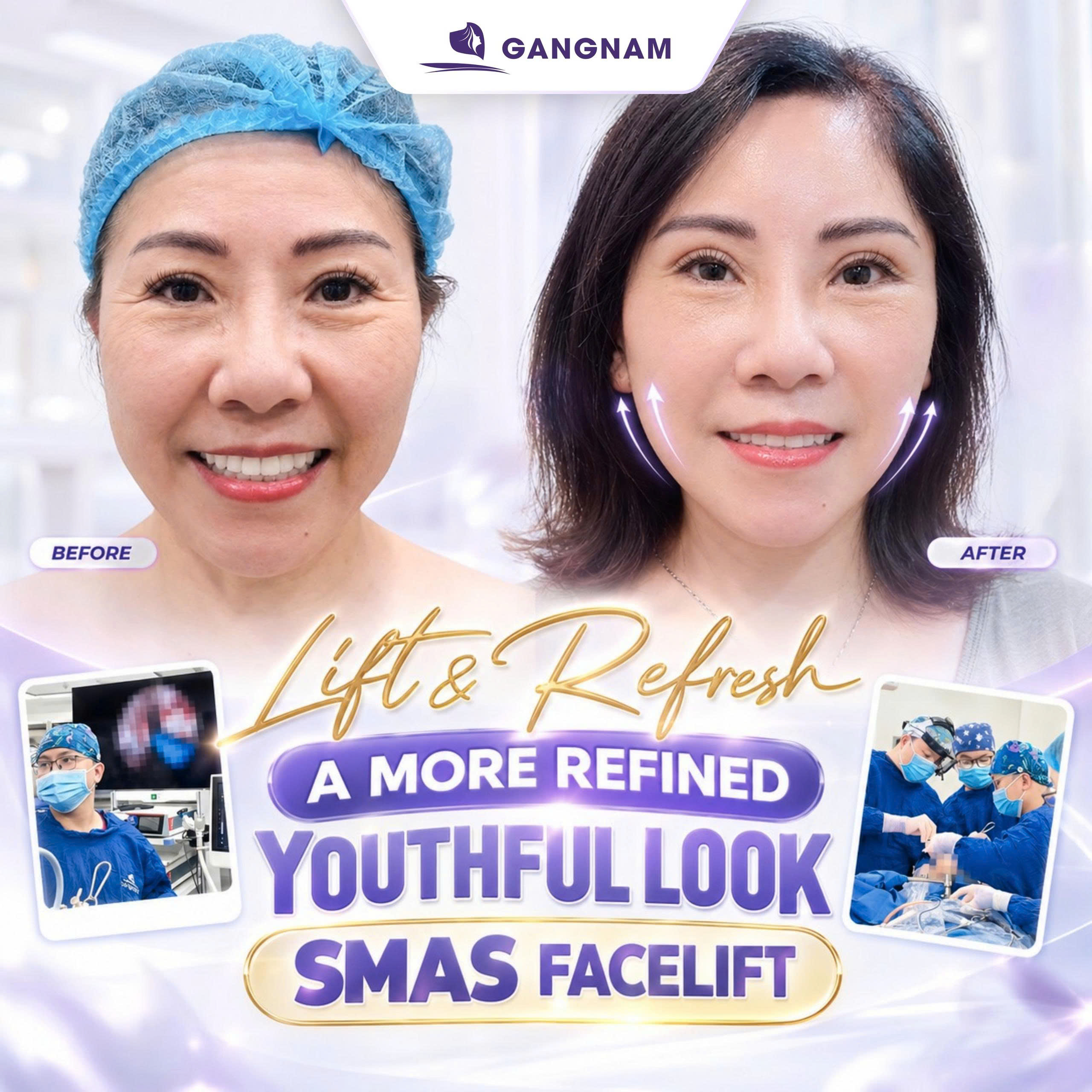 Căng da mặt nội soi là gì? Ưu điểm, quy trình và chi phí 6 Căng da mặt nội soi là gì? Ưu điểm, quy trình và chi phí 4