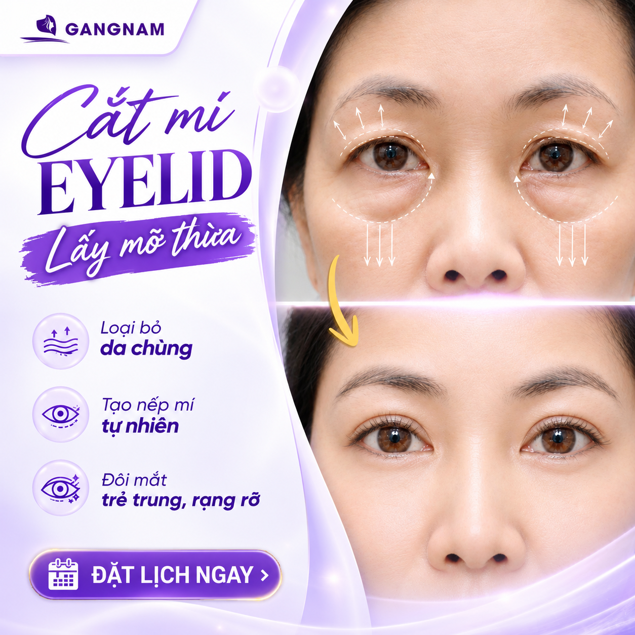 Cắt mí Eyelid lấy mỡ thừa: Giải pháp tạo mắt hai mí tự nhiên 4 Cắt mí Eyelid lấy mỡ thừa là gì?
