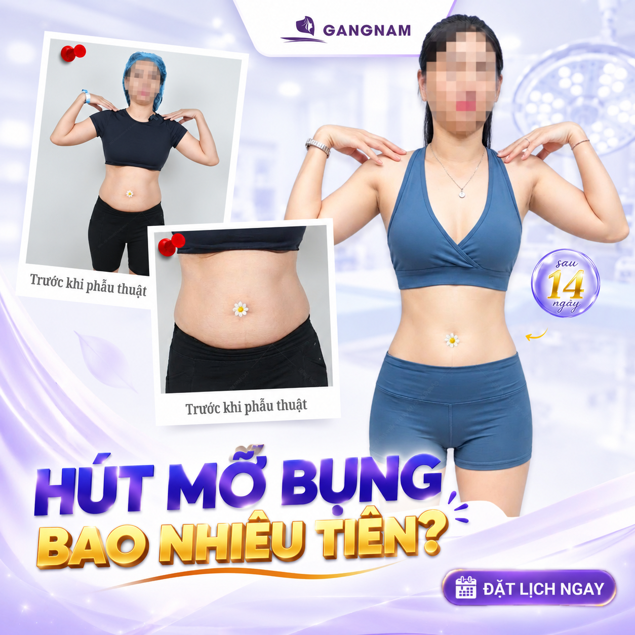 Hút mỡ bụng giá bao nhiêu tiền? Bảng giá mới nhất 2026 4 Hút mỡ bụng giá bao nhiêu tiền năm 2026?